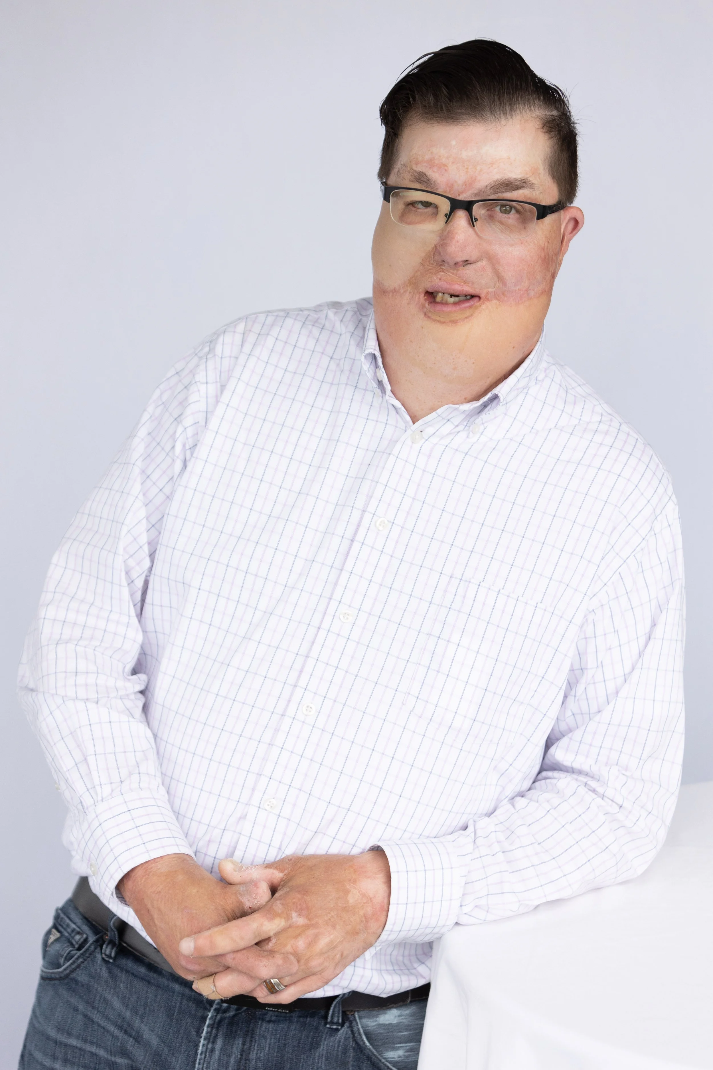 A man with skin condition and glasses, wearing a white checked shirt, stands against a plain background.