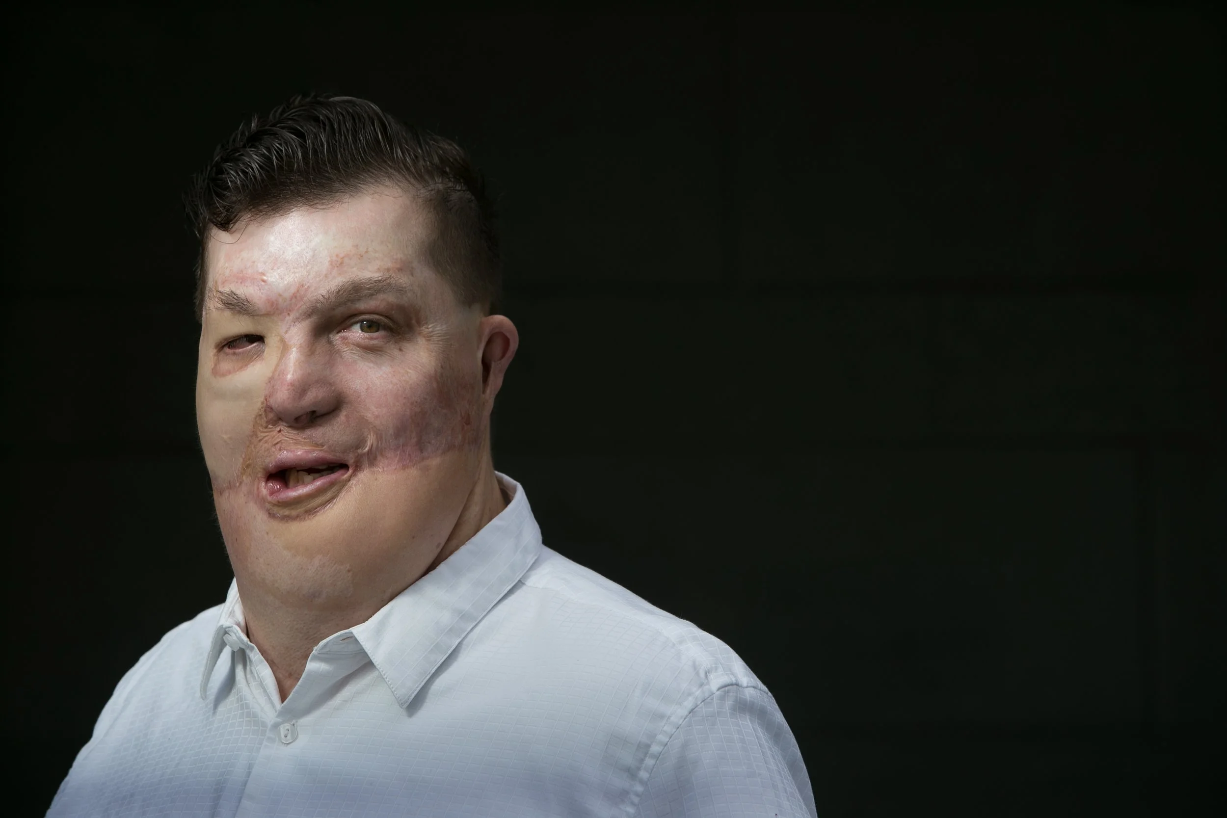 A man with facial scars and a distorted face, wearing a white shirt, against a dark background.