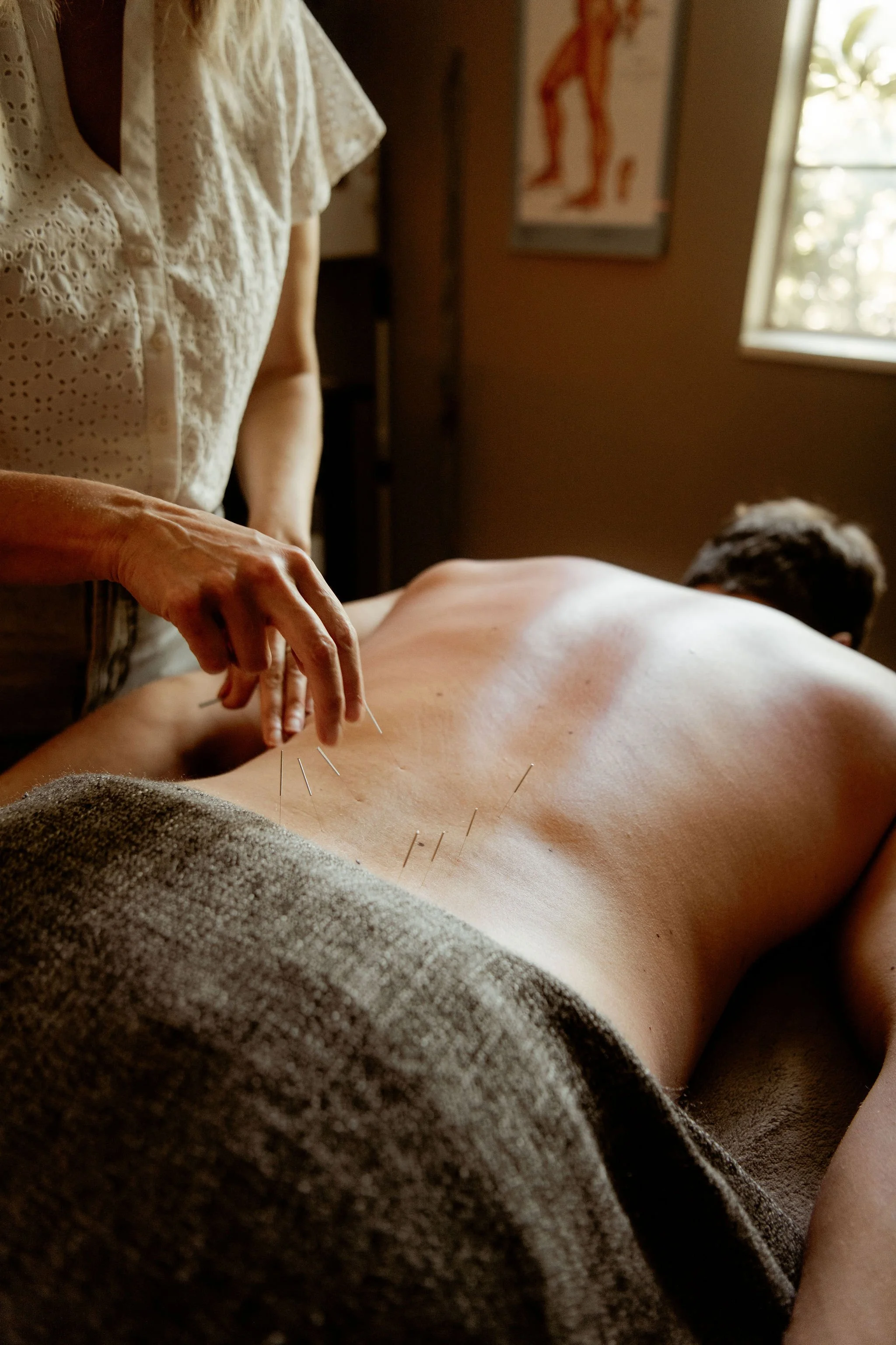 Acupuncture for Low Back Pain: What the Research Says and What to Expect