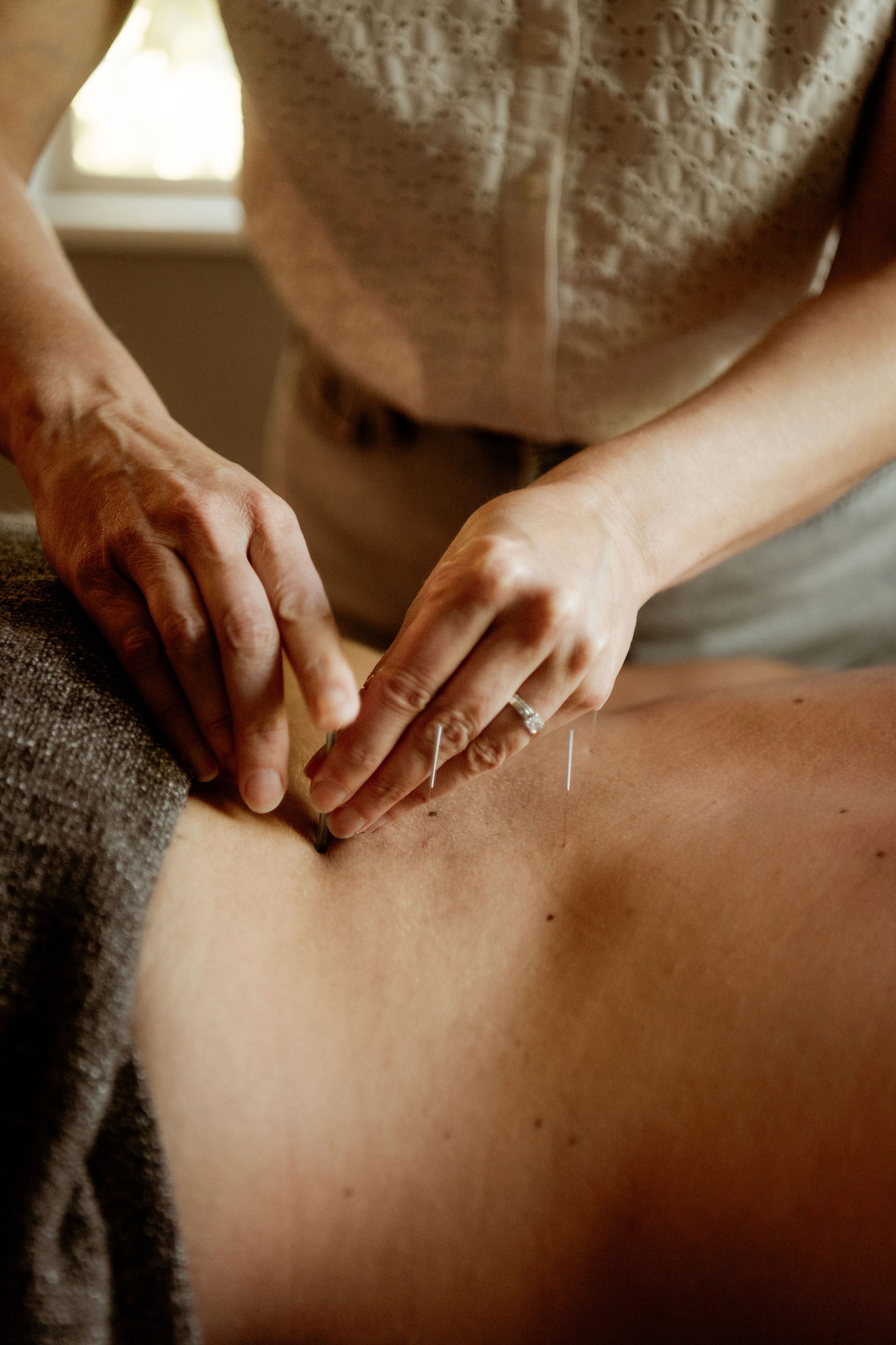 Person receiving acupuncture treatment on their lower back.