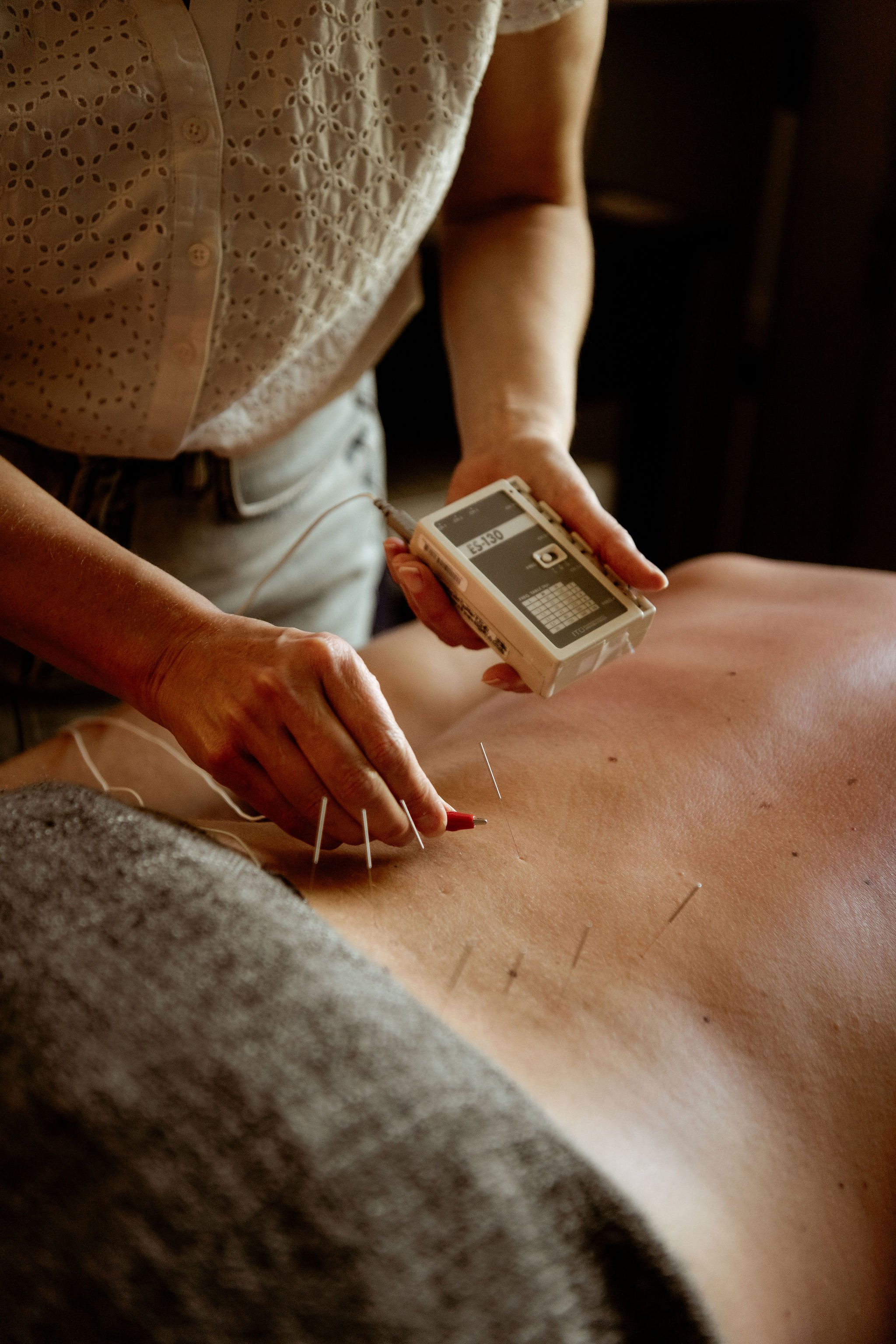 Close-up of electroacupuncture needles inserted into a person's skin, with wires attached, in a therapeutic setting.