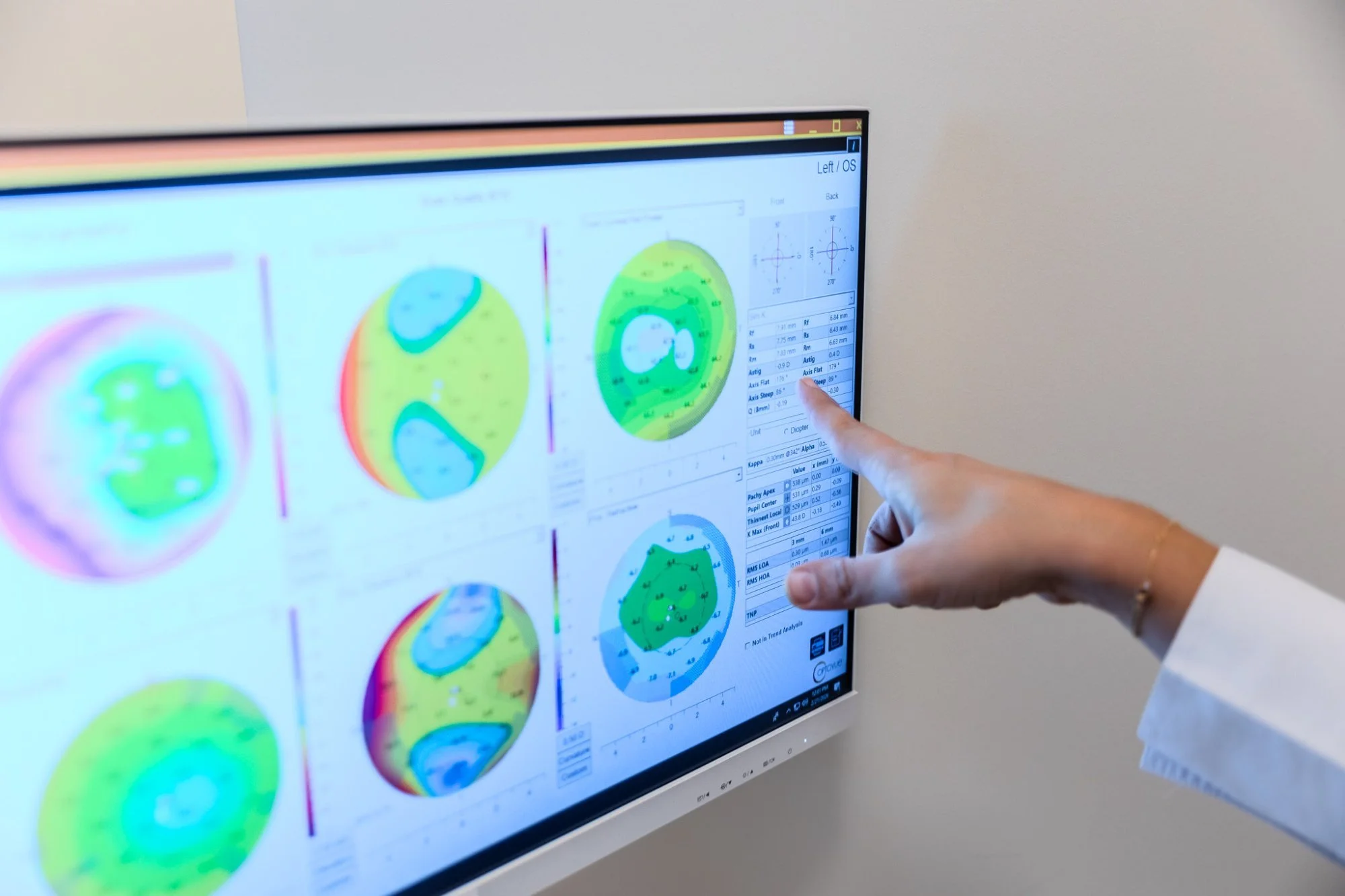 Analyse topographique cornéenne - Détection kératocône et adaptation lentilles Paris
