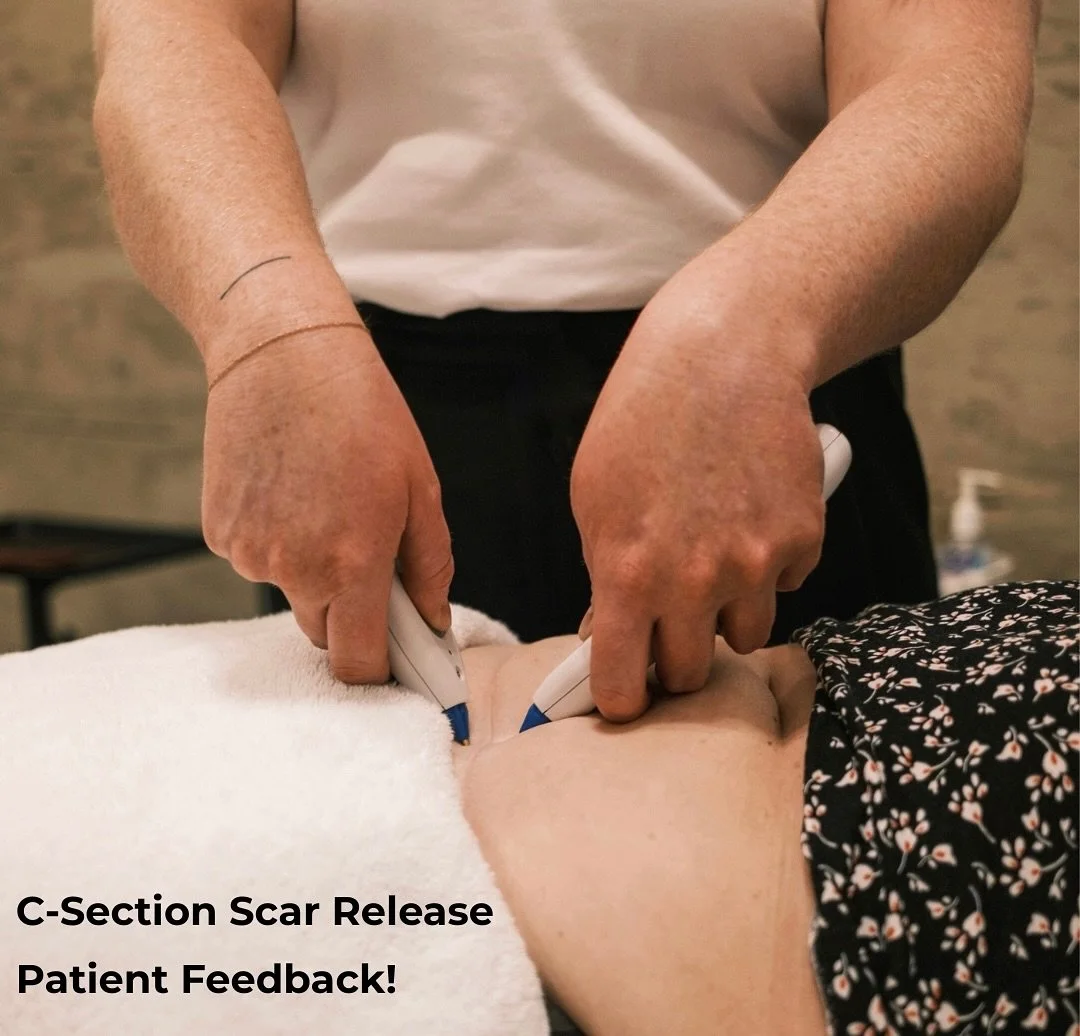 ✨ Real feedback from moms who&rsquo;ve tried our C-Section Scar Release Therapy ✨

&ldquo;I didn&rsquo;t even realize how tight my scar was at first. Now I can bend, twist, and just move again without thinking twice.&rdquo;

&ldquo;I feel more confid