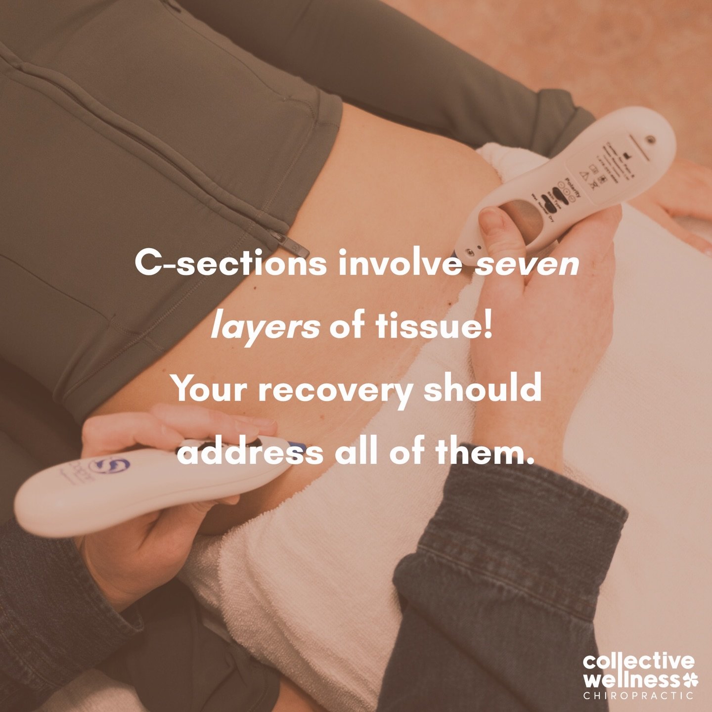 C-Section Scar Release Therapy uses a layered approach!

⚡ Dolphin Neurostim: Supports tissue repair, improves sensation, and reduces scar buildup
 🤲 IASTM: Loosens stuck tissue, breaks down adhesions, and helps the scar tolerate movement
 🍵 Cuppin