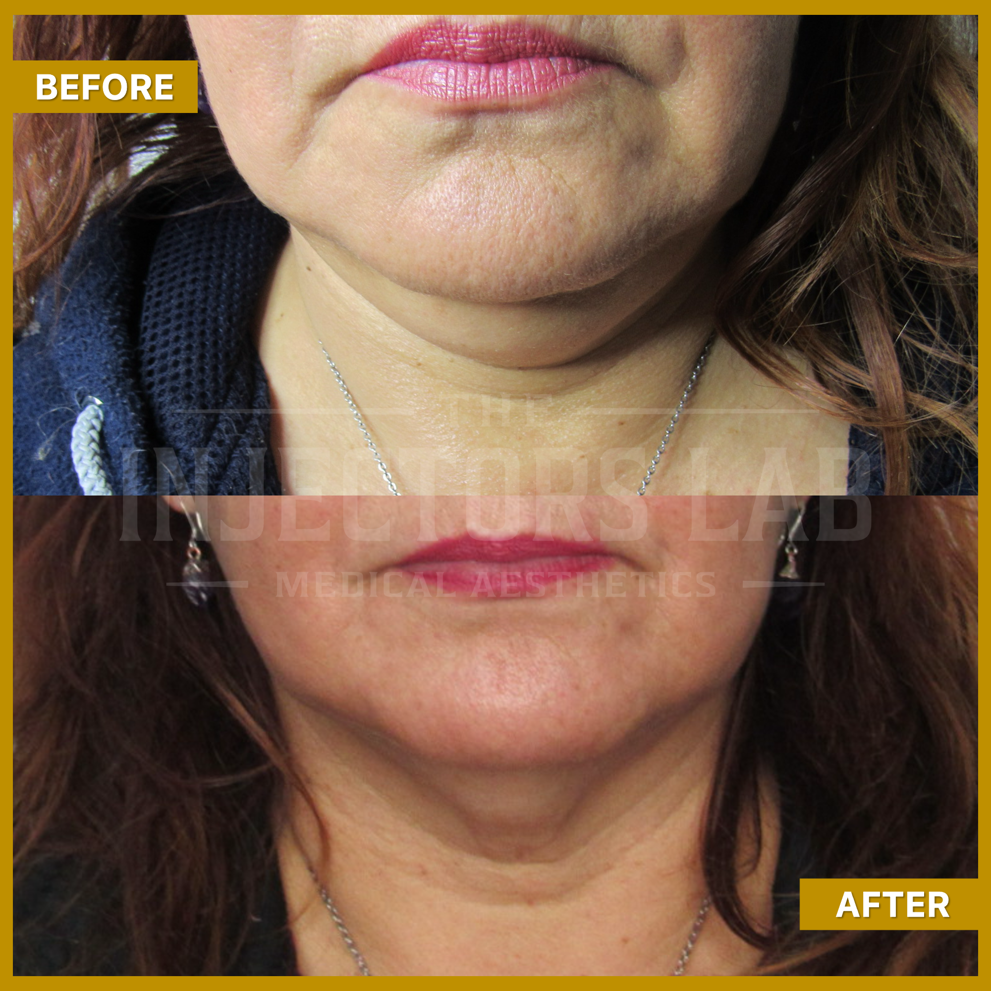 Before and after comparison of chin area, showcasing results from a cosmetic procedure at Injectors Lab Medical Aesthetics.