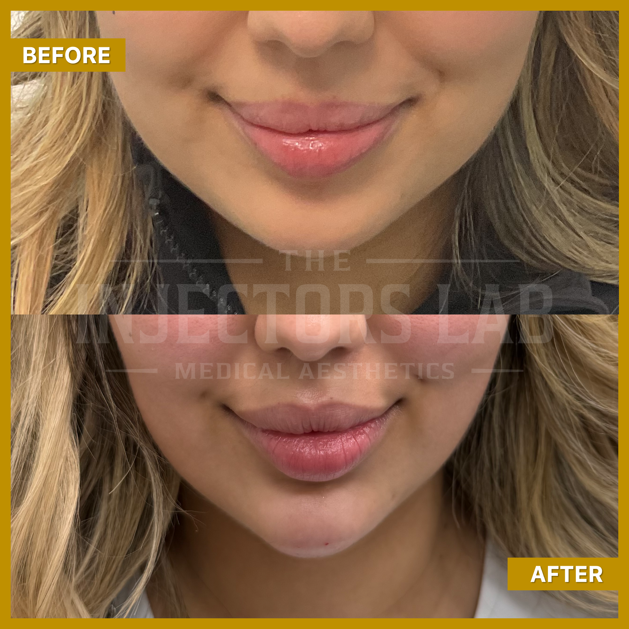 Before and after comparison showing lip enhancement results with a focus on the lips and lower face, featuring slight changes in fullness and contour.
