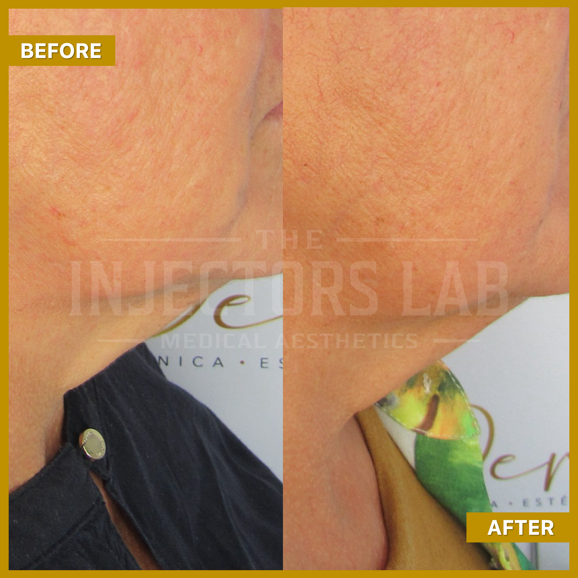 Before and after comparison of skin treatment on the neck, showing improved texture and tone. Left side labeled 'Before' and right side labeled 'After.'