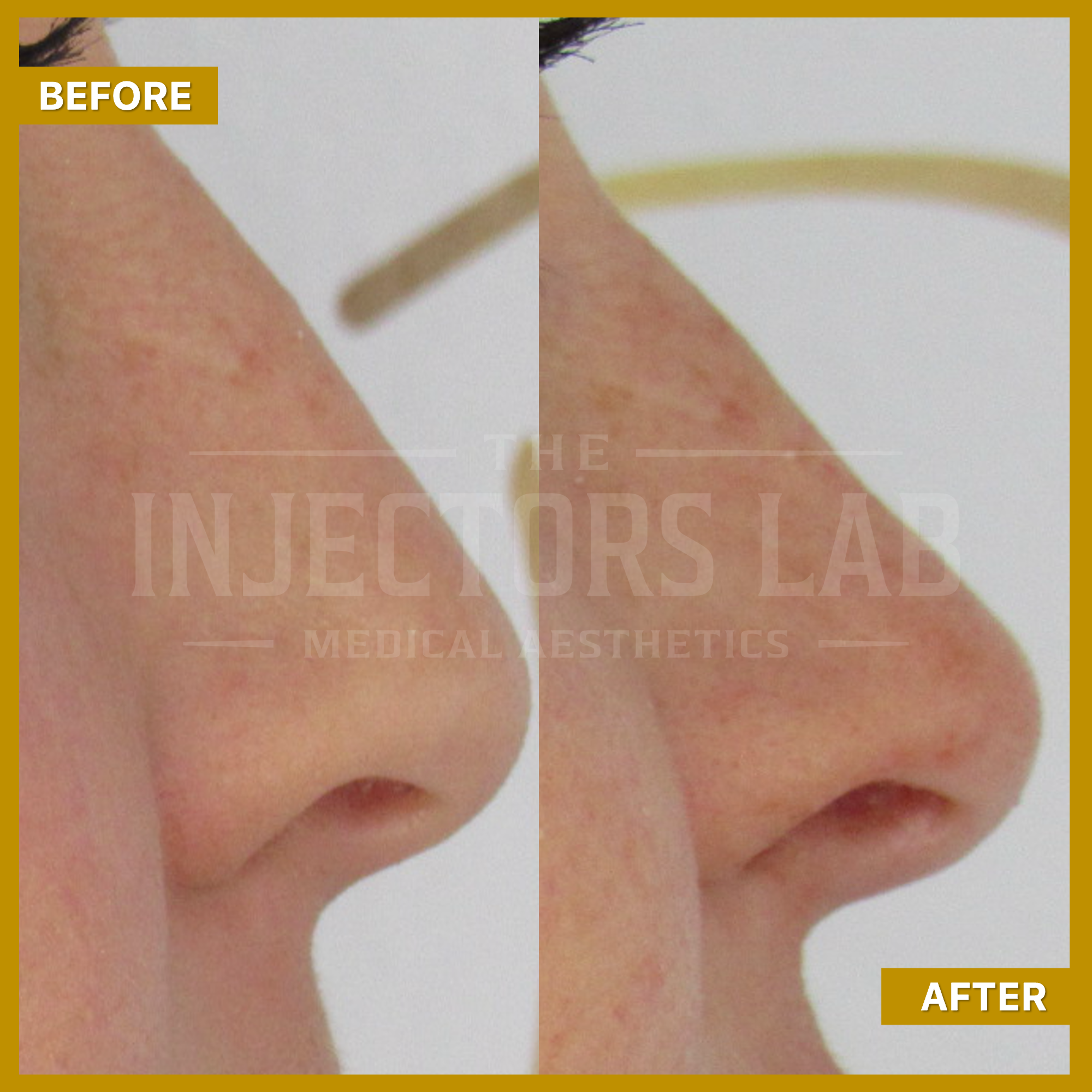 Before and after side profile view of a nose, showing changes in shape or contour potentially due to cosmetic treatment.