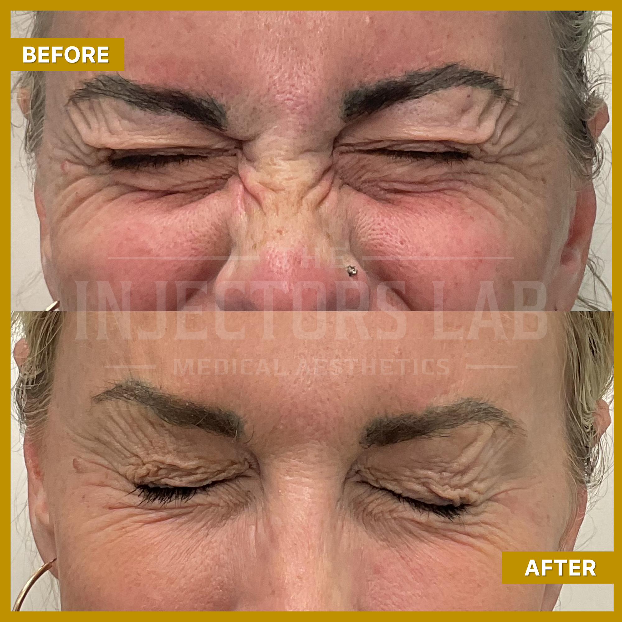 "Before and after images of a women's face focusing on reduced wrinkles between the eyebrows."