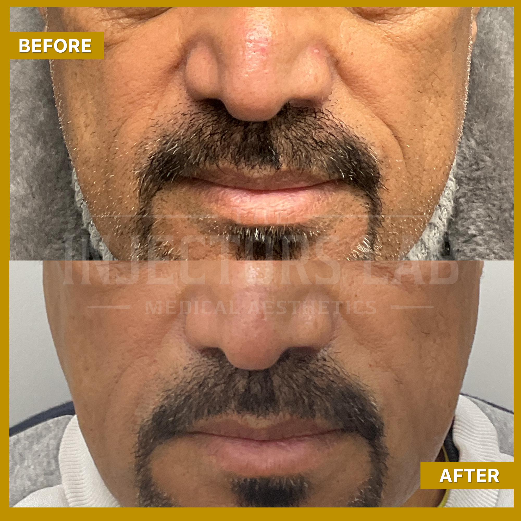 Before and after images showing a man's facial area, focusing on the mouth and chin, highlighting changes in skin texture and appearance.