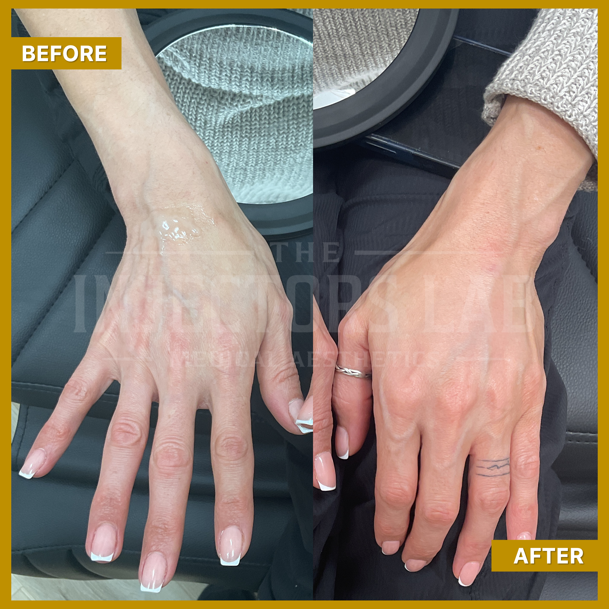 Split image showing a hand labeled 'Before' and 'After' treatment, with visible changes in skin texture and tone.
