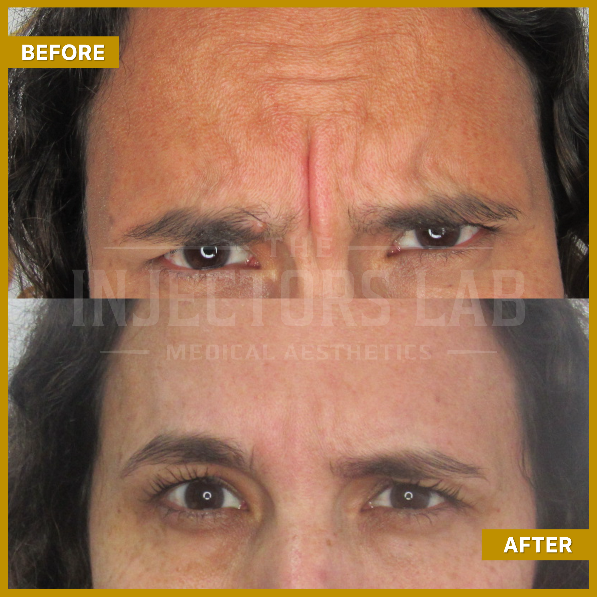 A split image showing a close-up of a person's forehead and eyes, labeled 'Before' and 'After.' The 'Before' image shows visible wrinkles on the forehead, while the 'After' image shows a smoother forehead.