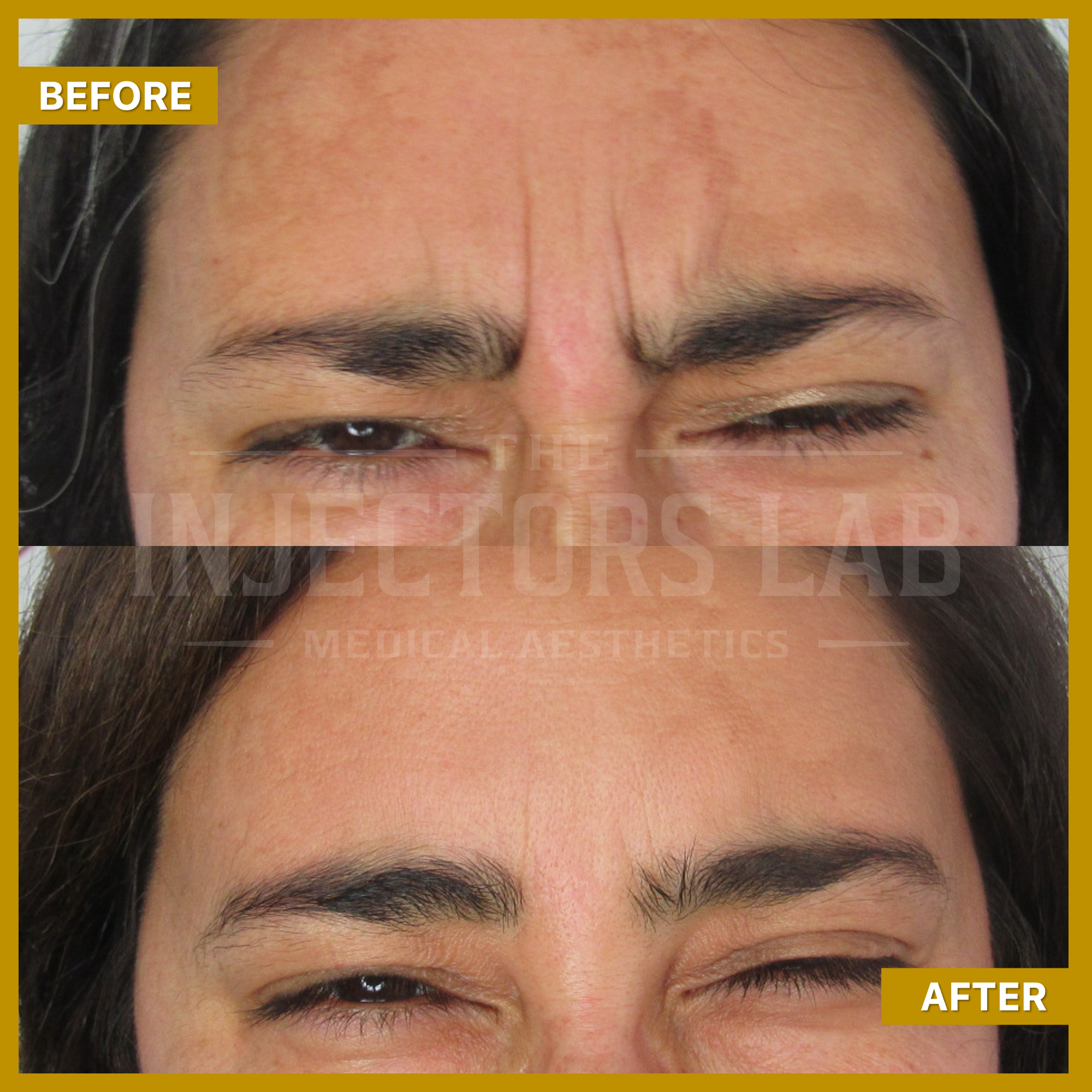 Before and after comparison of facial wrinkles between eyebrows, with noticeable improvement.