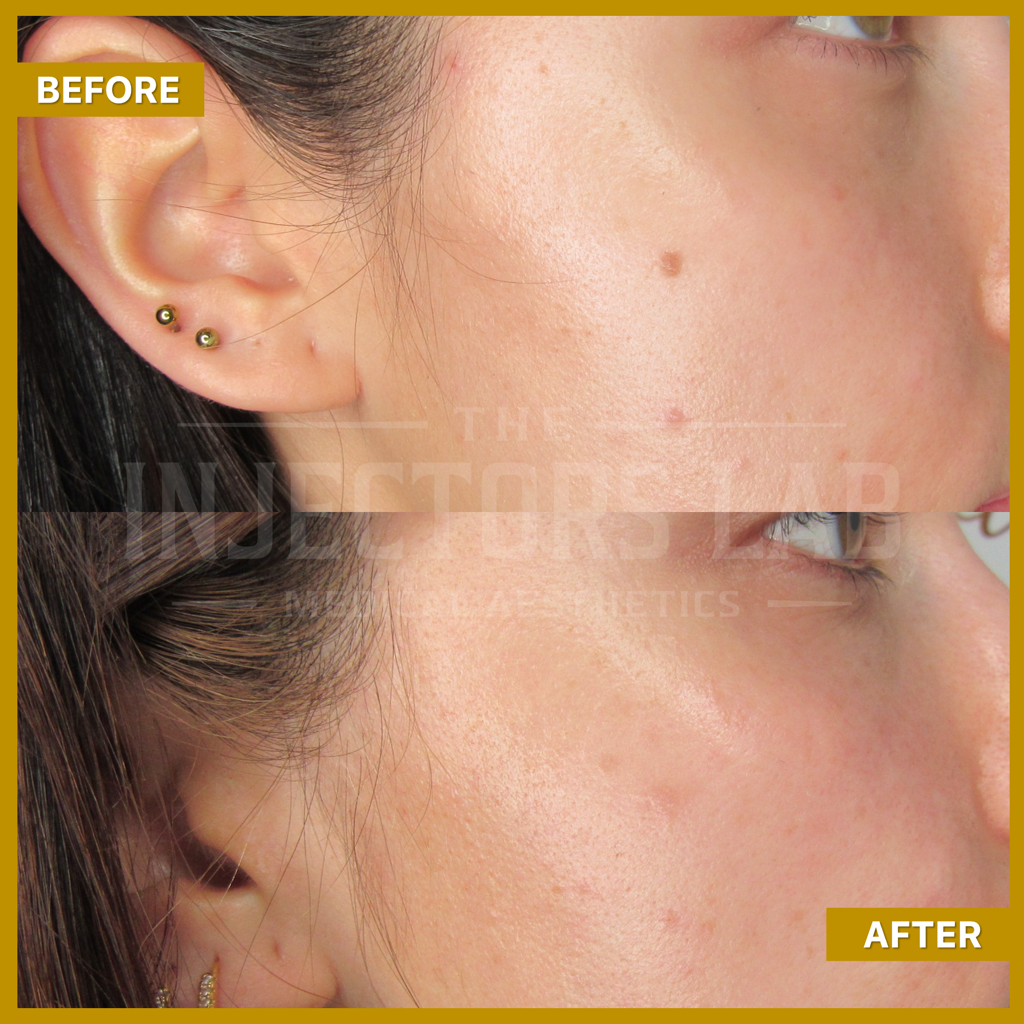 Side-by-side comparison of facial skin with acne scars before and after treatment, showing smoother skin texture in the 'after' image.
