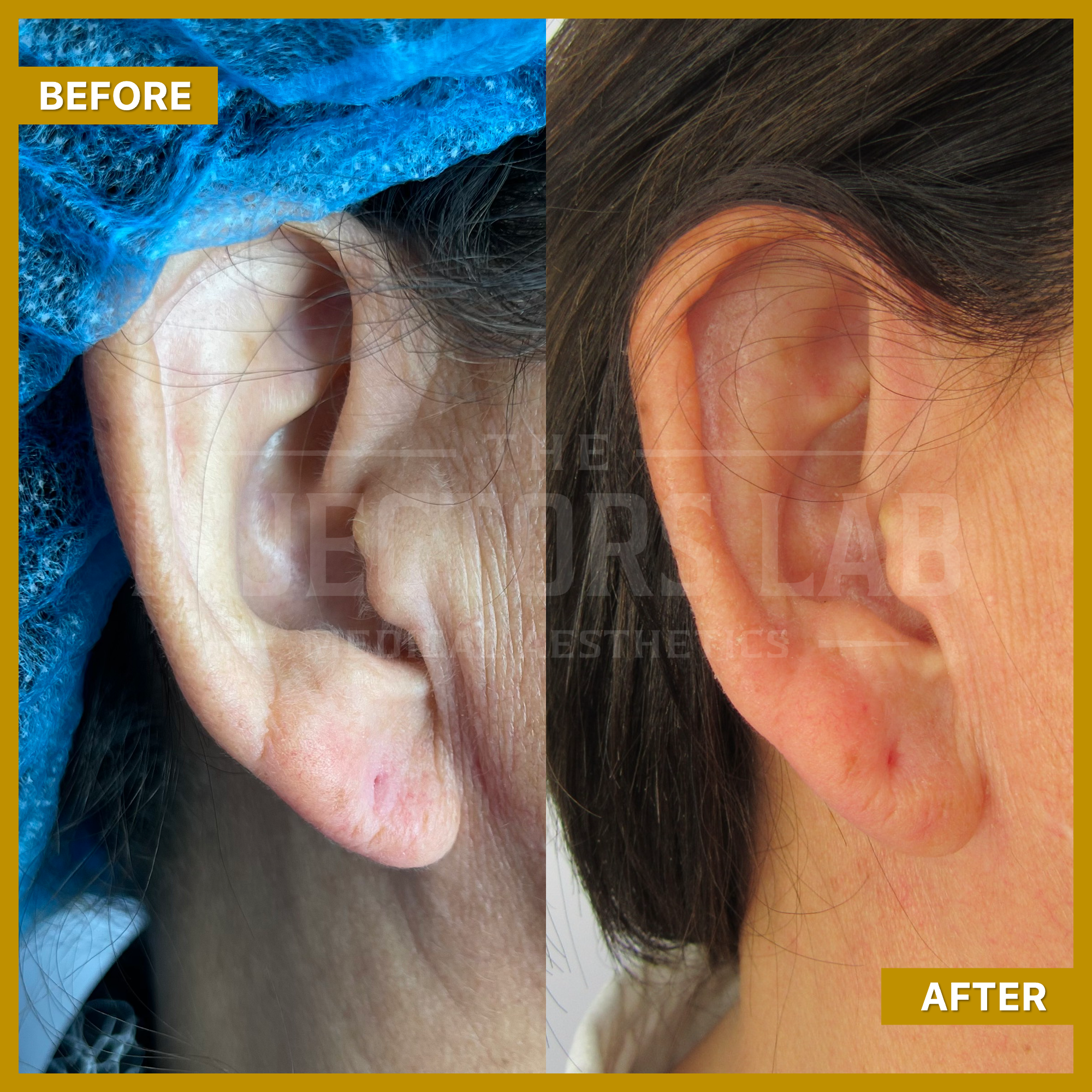 Before and after ear surgery comparison featuring close-up images of an ear. The left side, labeled 'Before,' shows the ear in its original state, while the right side, labeled 'After,' shows the ear post-surgery with visible improvements.