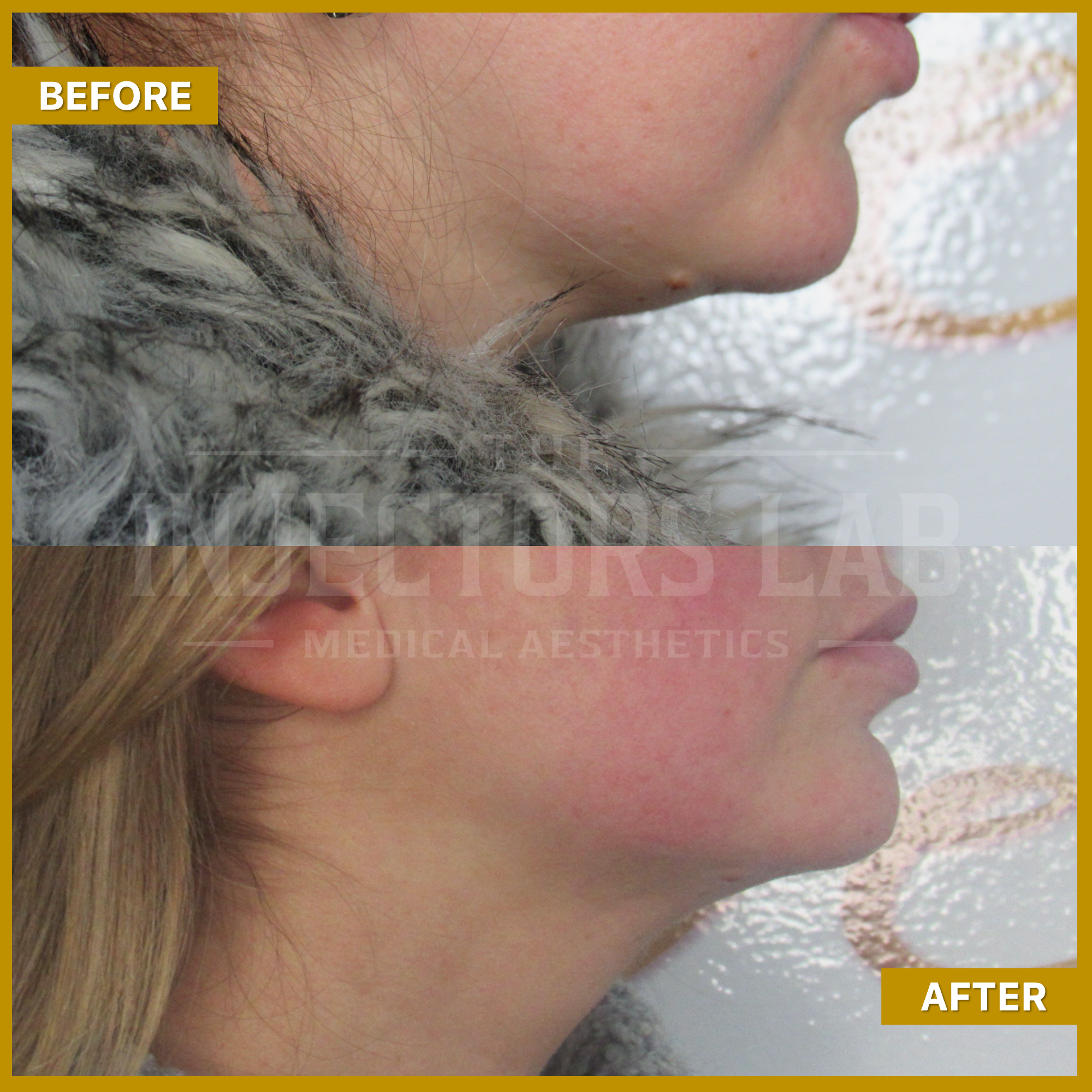 Before and after side profile images showing changes in neck and jawline appearance following a cosmetic procedure.