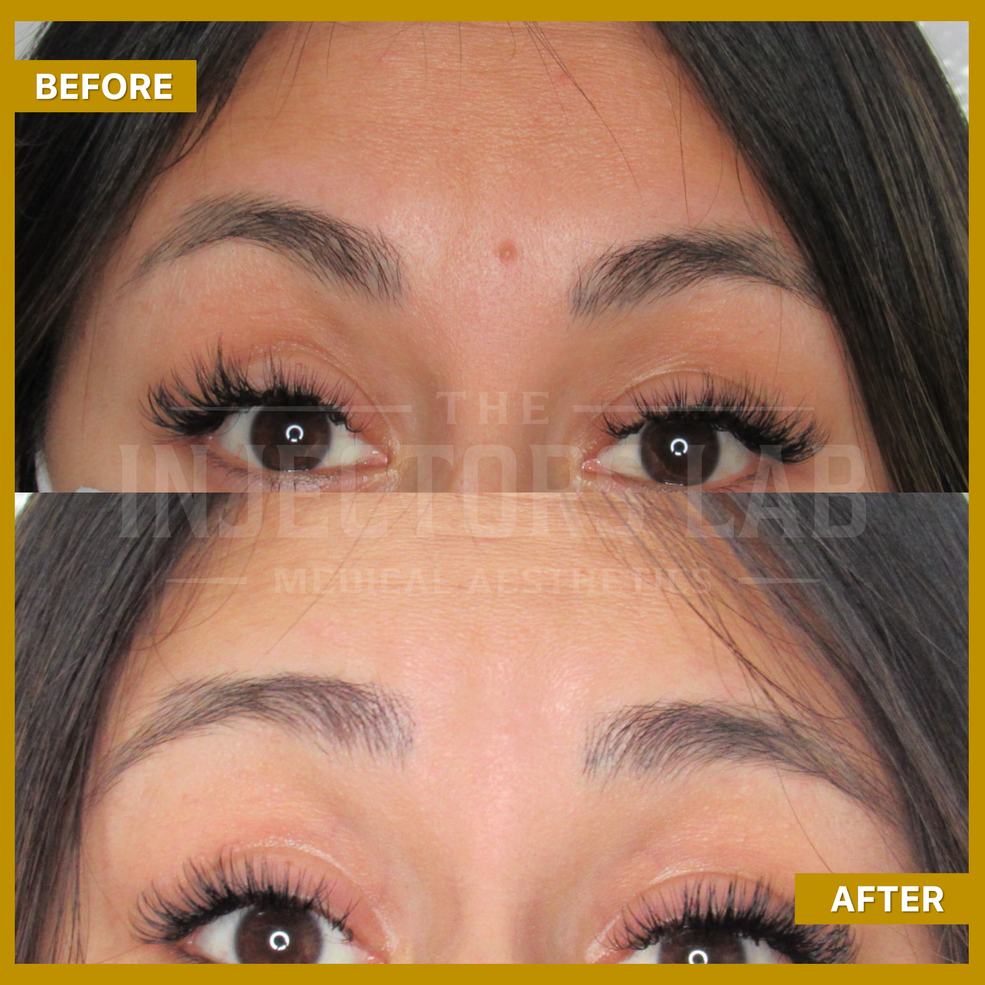 Comparison of a woman's forehead and eyebrows before and after a cosmetic procedure, with notable changes in skin texture and eyebrow positioning. Text labels indicate 'Before' and 'After'."