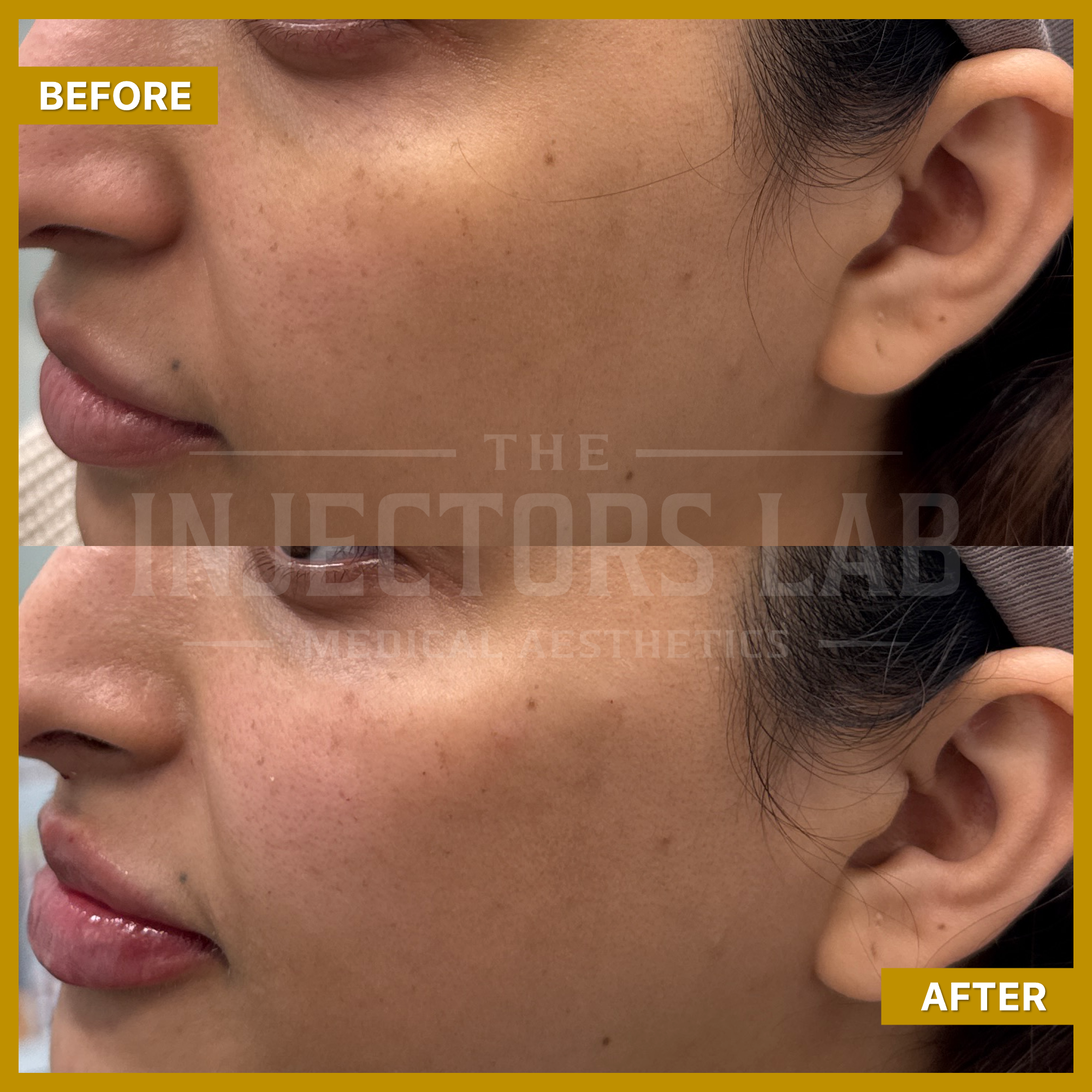Before and after images showing skin treatment results on a person's face.