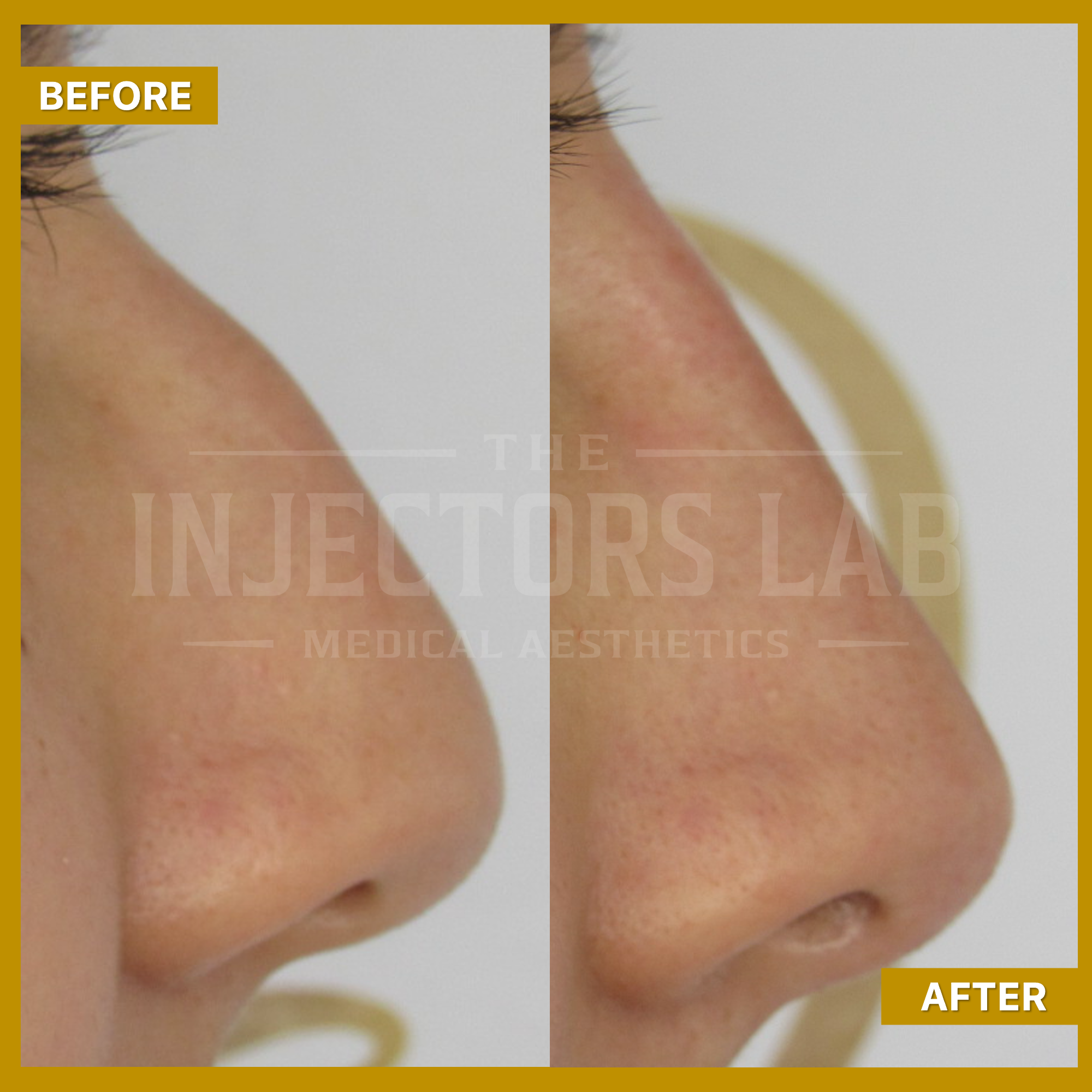 Before and after photo of a person's nose, showing changes in contour and structure, indicating a procedure from The Injectors Lab Medical Aesthetics.