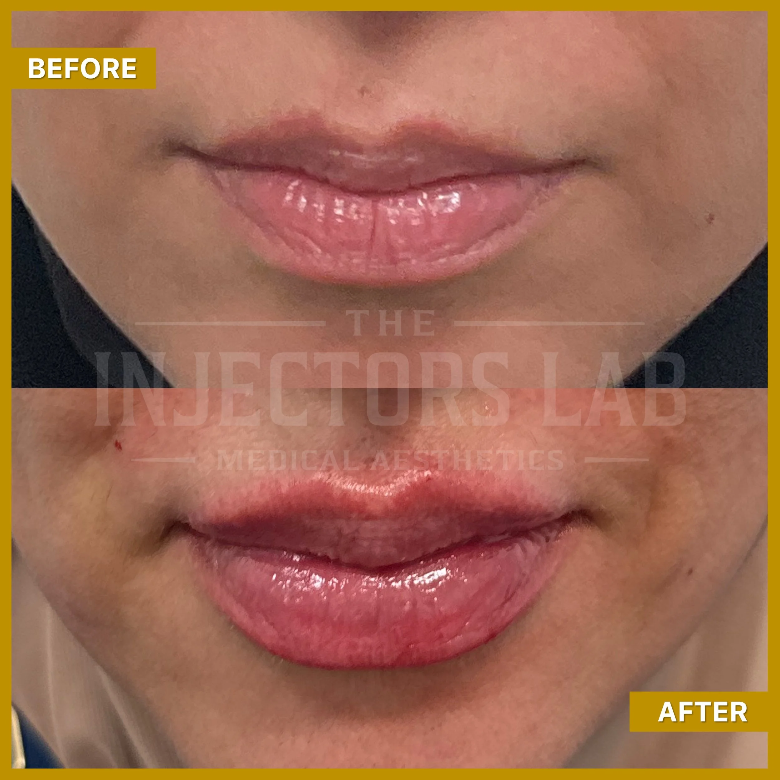 Before and after lip enhancement procedure showing subtle lip fullness increase.
