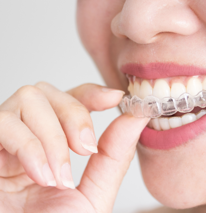 Close-up of a woman wearing a clear dental retainers.