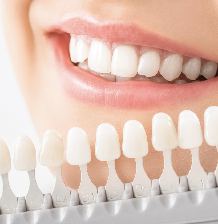 Close-up of a person's smile showing their teeth, with a shade guide display in front.