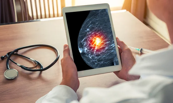 Two trusts trial AI to diagnose breast cancer sooner