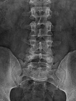 lumbar spine x-ray. X-rays taken in house. treatment for low back pain.