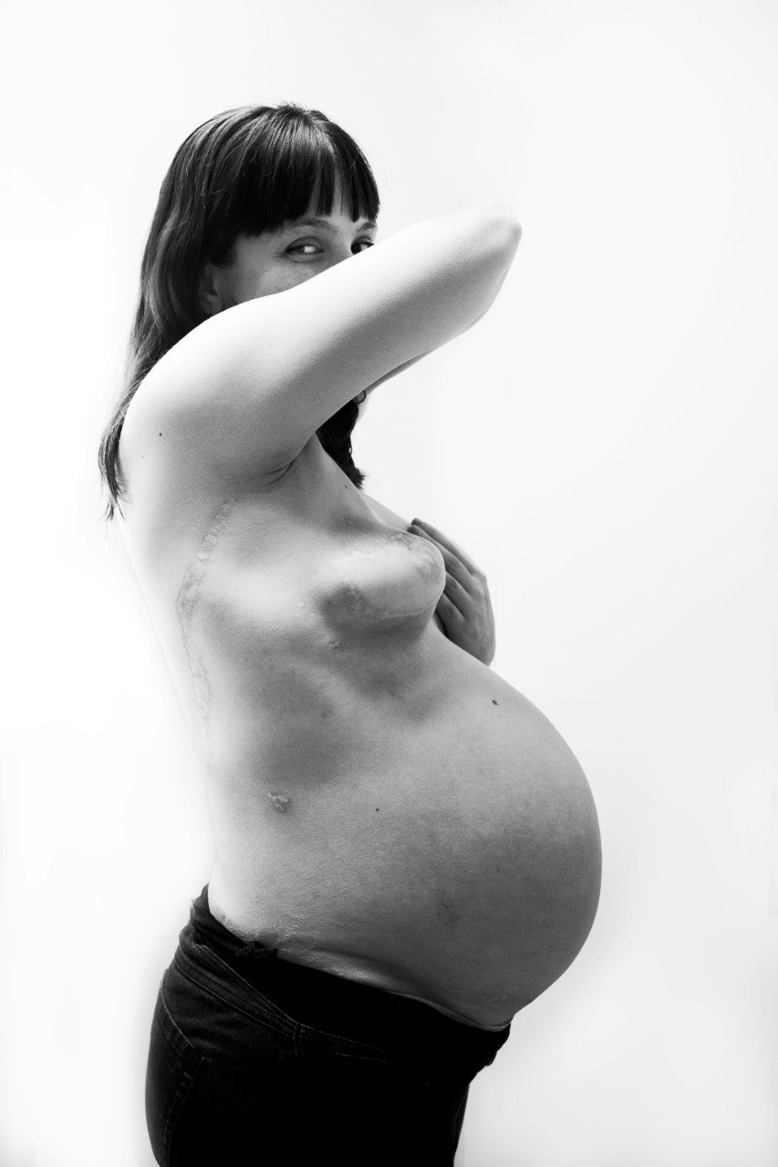 Black and white portrait of a pregnant woman who is a breast cancer survivor with one arm covering covering her face, standing against a plain light background. Her scars are visible across her body