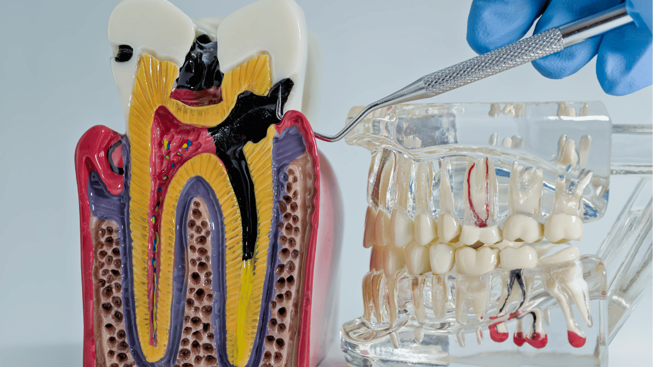 Your Guide to Tooth Extraction and Root Canal Alternatives