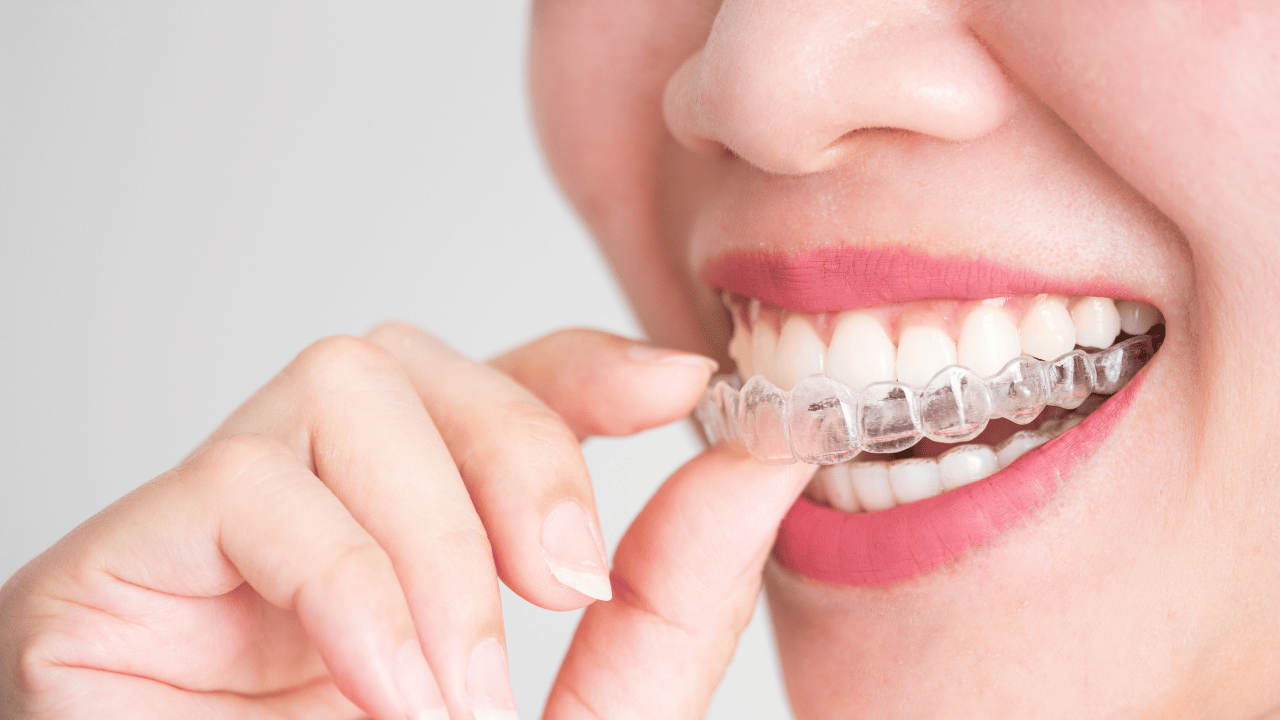 Achieve Your Perfect Smile with Invisalign Clear Aligners