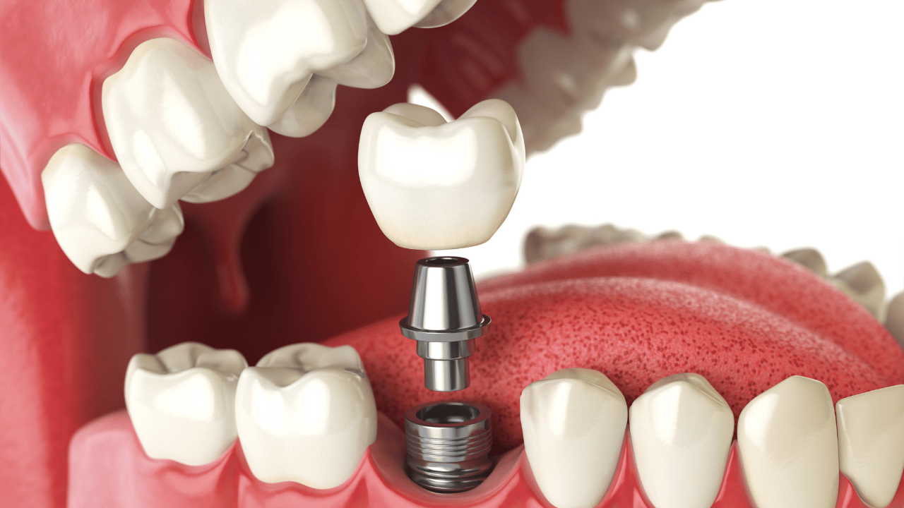 Your Comprehensive Guide to Implant Dentistry in Tulsa