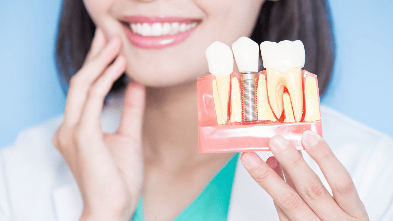 How Do All-on-4 Implants Compare in Recovery Time?