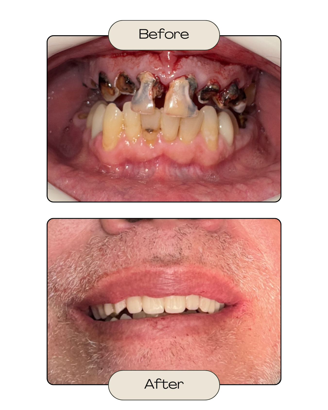 Comparison of dental condition before and after dental treatment, showing severely decayed and damaged teeth in the top image and healthy, cleaned teeth in the bottom image.