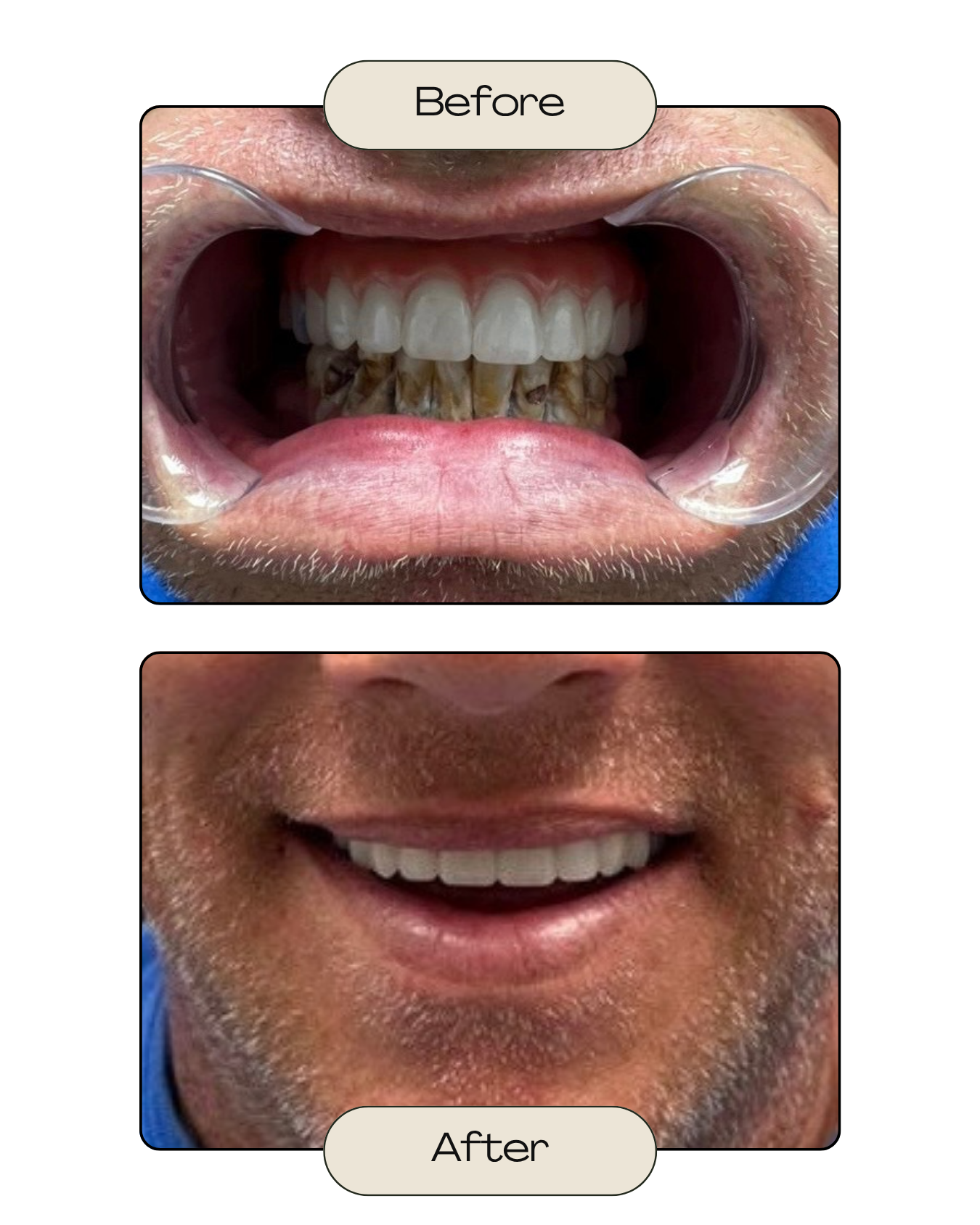 Comparison of a person's smile before and after dental treatment. The "before" image shows discolored and decayed teeth, while the "after" image shows clean, white teeth and a smiling face.