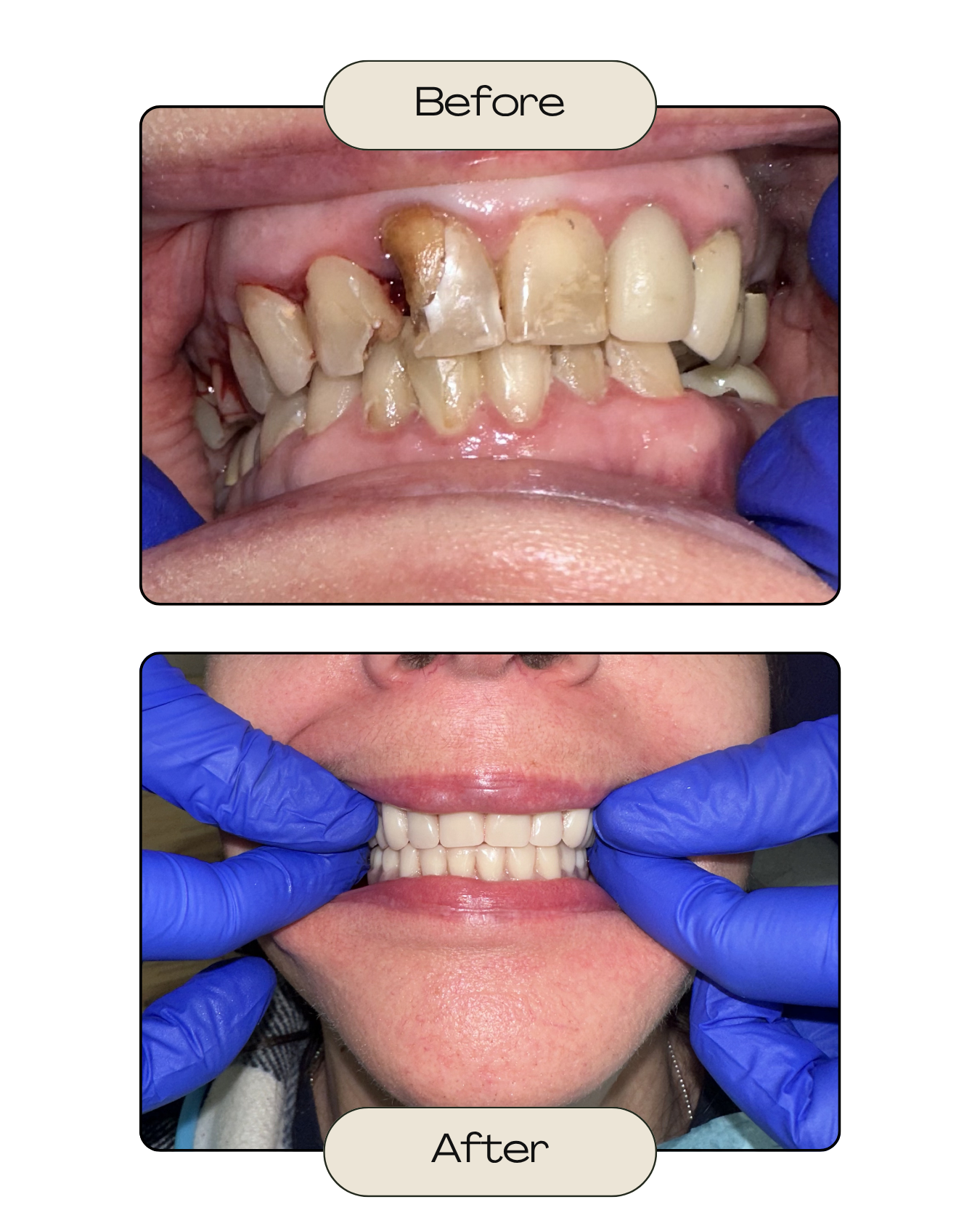 Comparison of teeth before and after dental restoration. The 'before' section shows severely decayed, discolored, and damaged teeth, while the 'after' section displays healthy, white, and evenly aligned teeth.