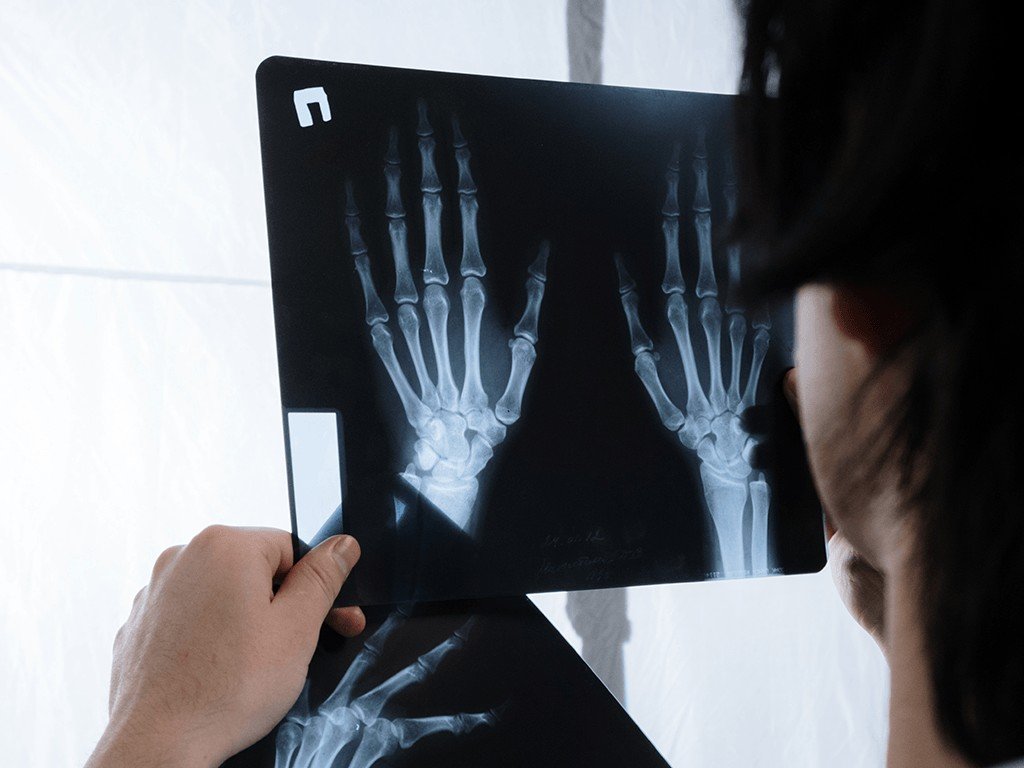 Qual a diferença entre Osteopenia e Osteoporose?