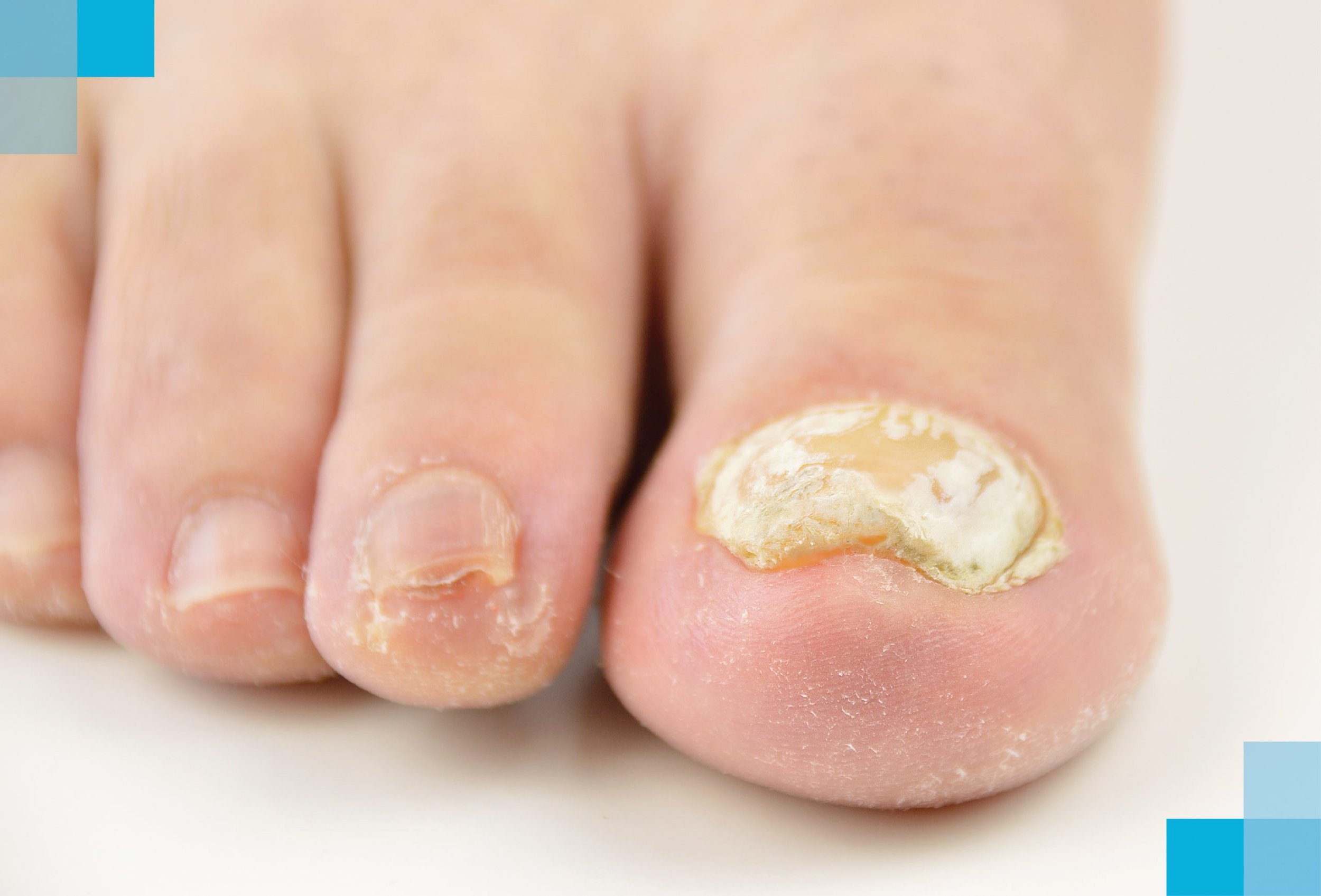 Onicomicose: o que é a micose nas unhas, causas e tratamento