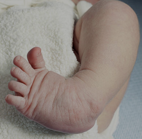 Clubfoot and Physiotherapy: Supporting Your Childs Journey