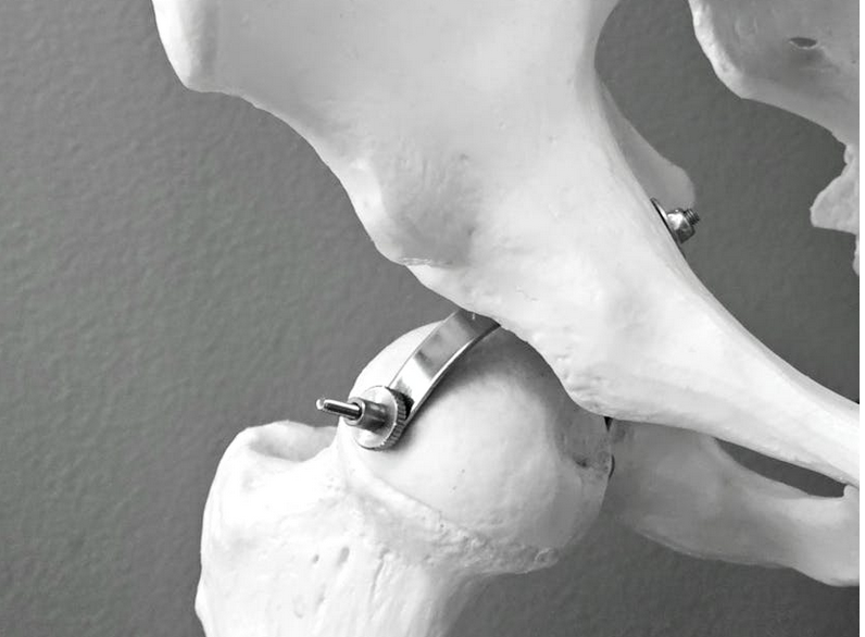 Hip Impingement: Understanding Your Hip Pain