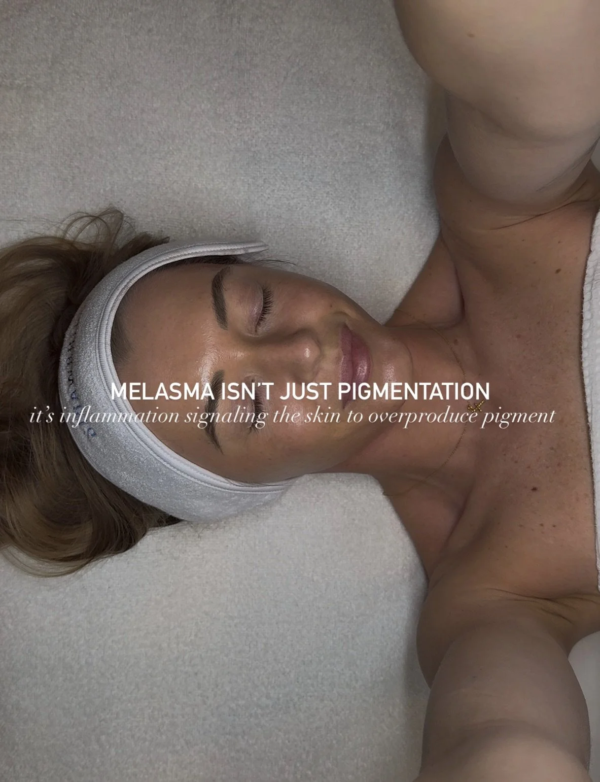 Inflammation was reduced first. Triggers were managed. Treatments and home care were selected for consistency, not speed.

True correction begins with calming the skin, supporting the barrier, and using brightening ingredients that communicate with t