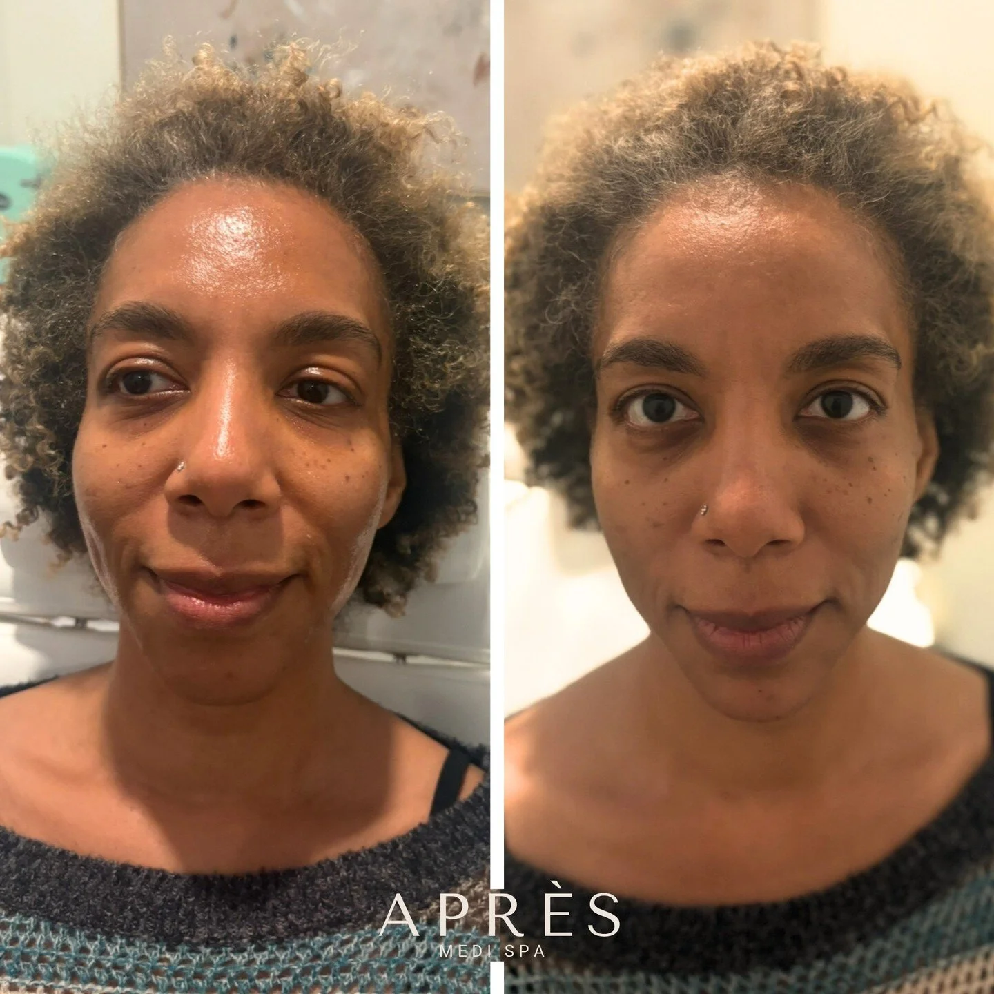 ✨ Facial Rejuvenation &amp; Balance ✨

Here&rsquo;s one of our lovely patients experiencing the transformative effects of filler! By subtly enhancing facial contours, and balancing the face. The results are natural, refreshed, and radiant, just what 