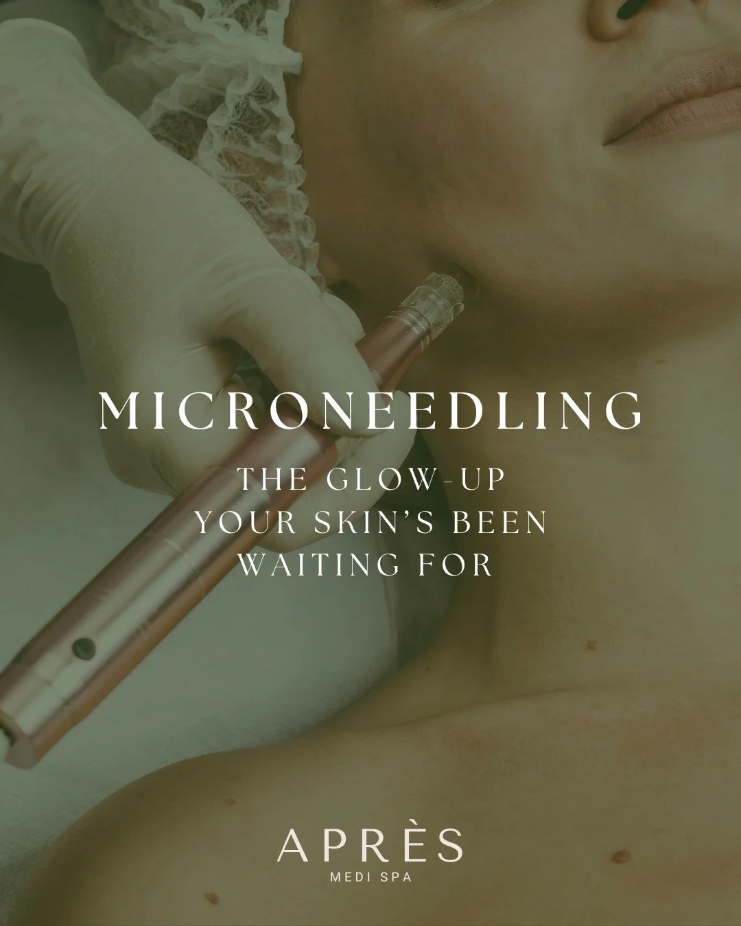 ✨Glow from the inside out ✨

Microneedling is more than a treatment&mdash;it&rsquo;s your skin&rsquo;s natural reset. By stimulating collagen and elastin, it smooths texture, minimizes fine lines, fades scars, and leaves your complexion radiant.

You