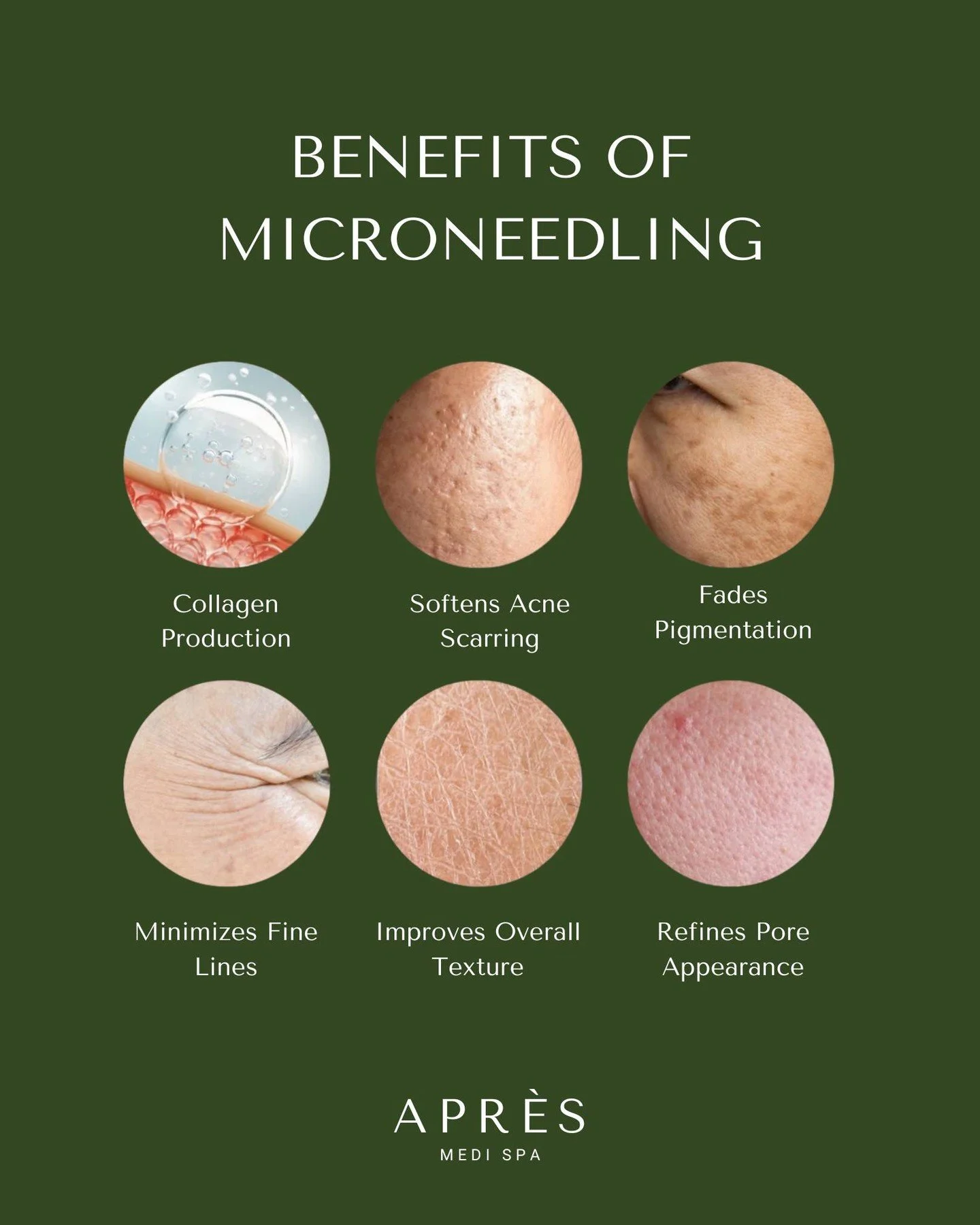 Collagen stimulation.
Smoother texture.
Brighter, healthier skin.

Microneedling works with your body&rsquo;s natural healing process to restore and refine your skin from within.

Book your microneedling treatment at Apr&egrave;s Medi Spa!