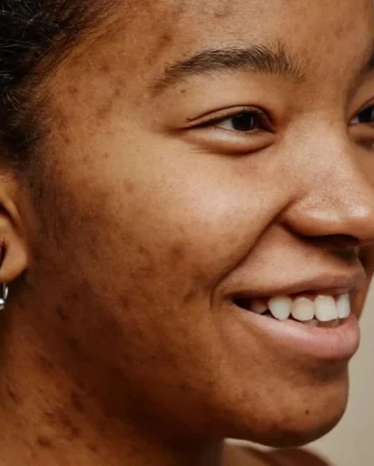 Hyperpigmentation &amp; Uneven Tone