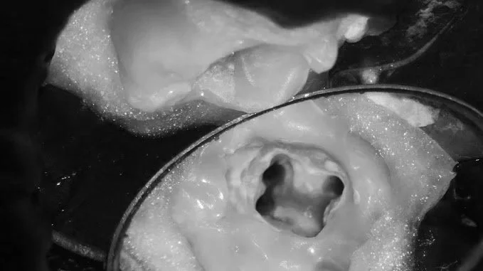 Tratamentul de canal sub microscopul stomatologic: molar deschis – caz clinic din cabinetul stomatologic al dr. Resch-Sipos din Tettnang