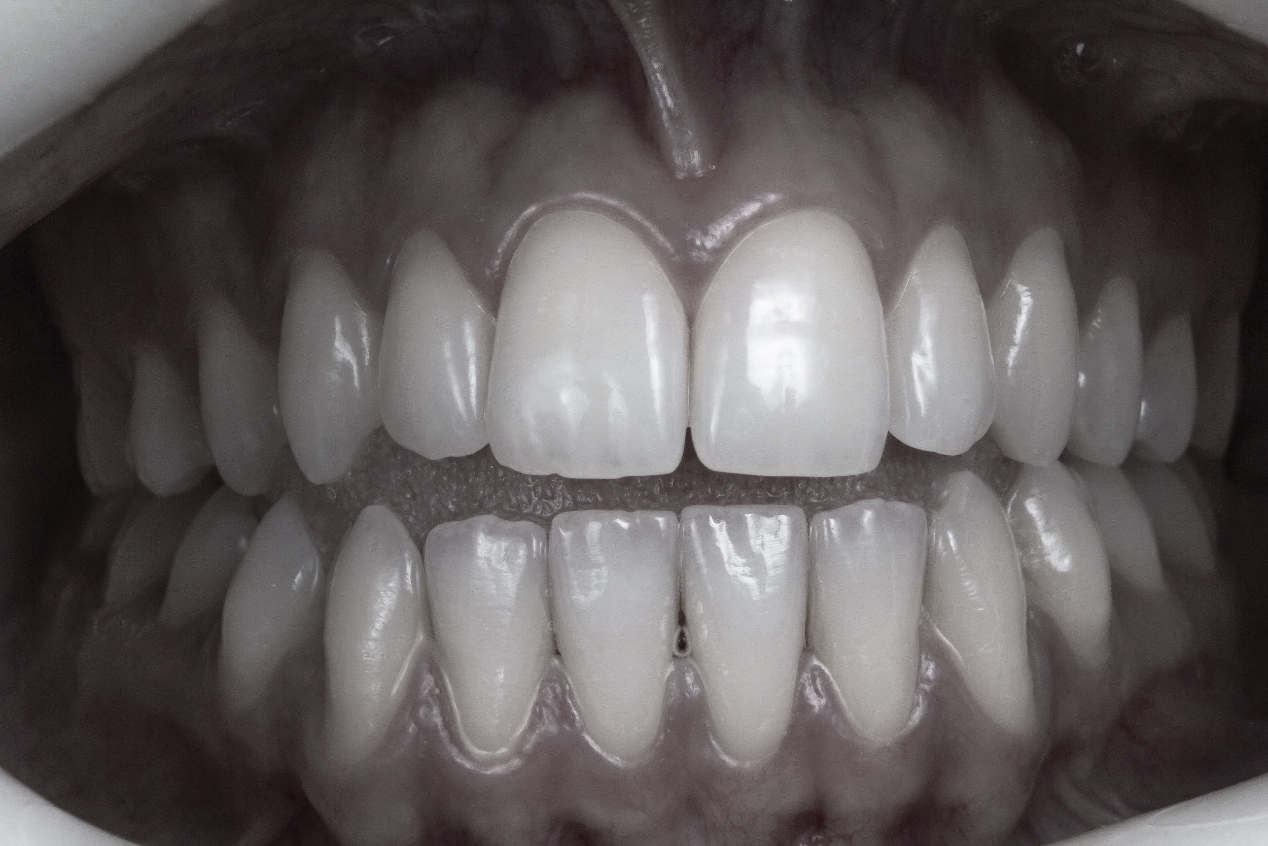 Close-up of a person's open mouth showing clean, white teeth and gums.