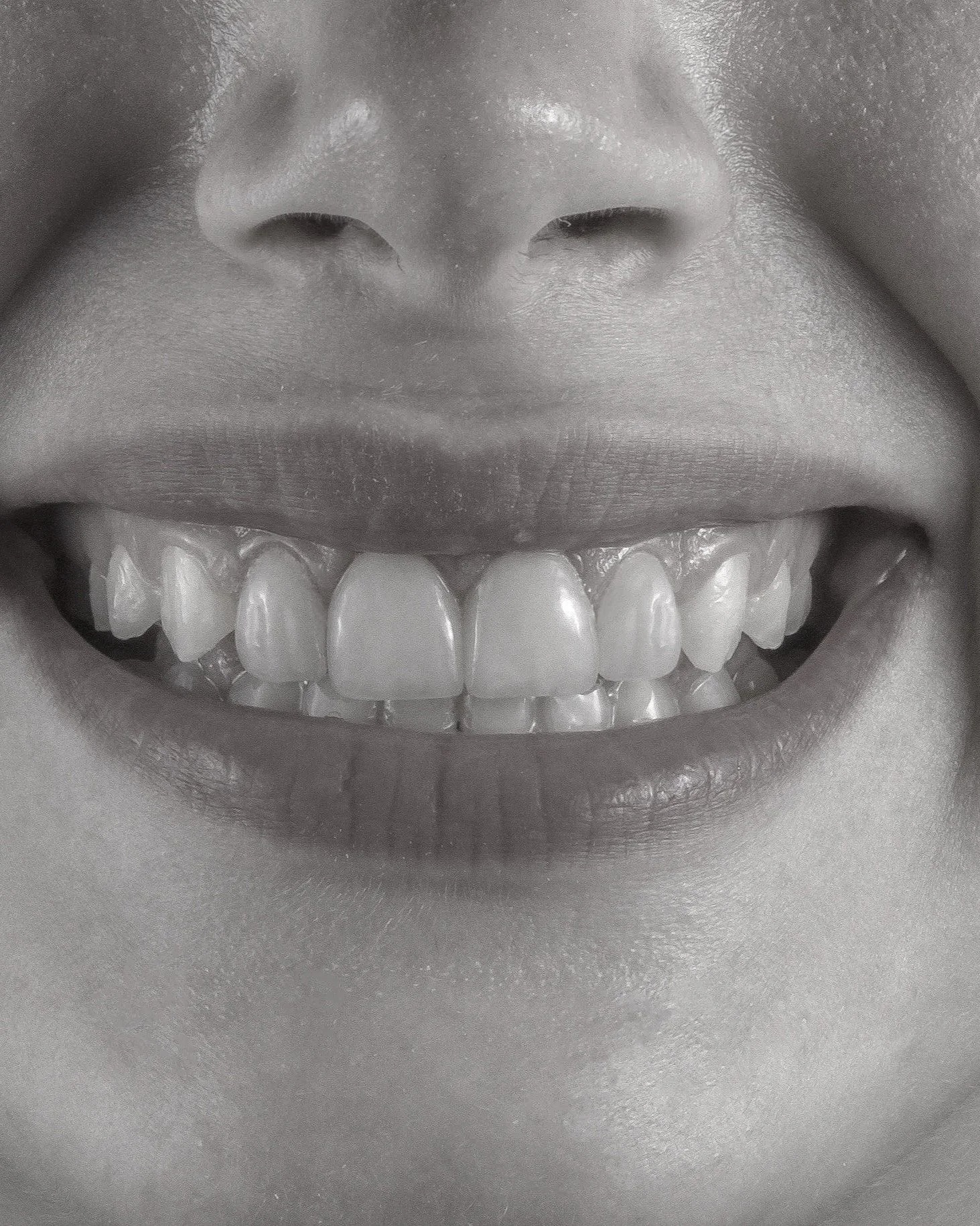 Close-up black-and-white photograph of a smiling person showing their upper and lower teeth.