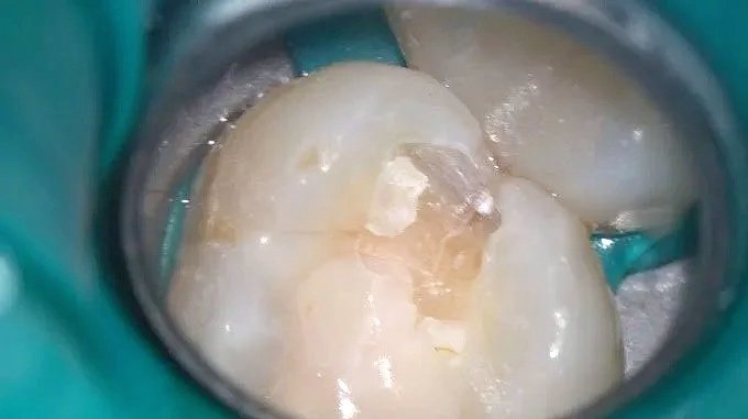 Dinte molar cu carie, sub barieră de cauciuc, înainte de tratamentul de obturare