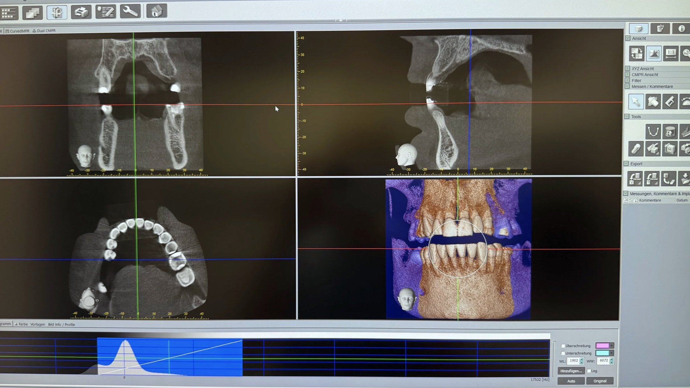 Dental X-ray scans showing 3D models of teeth and jawbones aligned in four quadrants on a medical imaging screen.